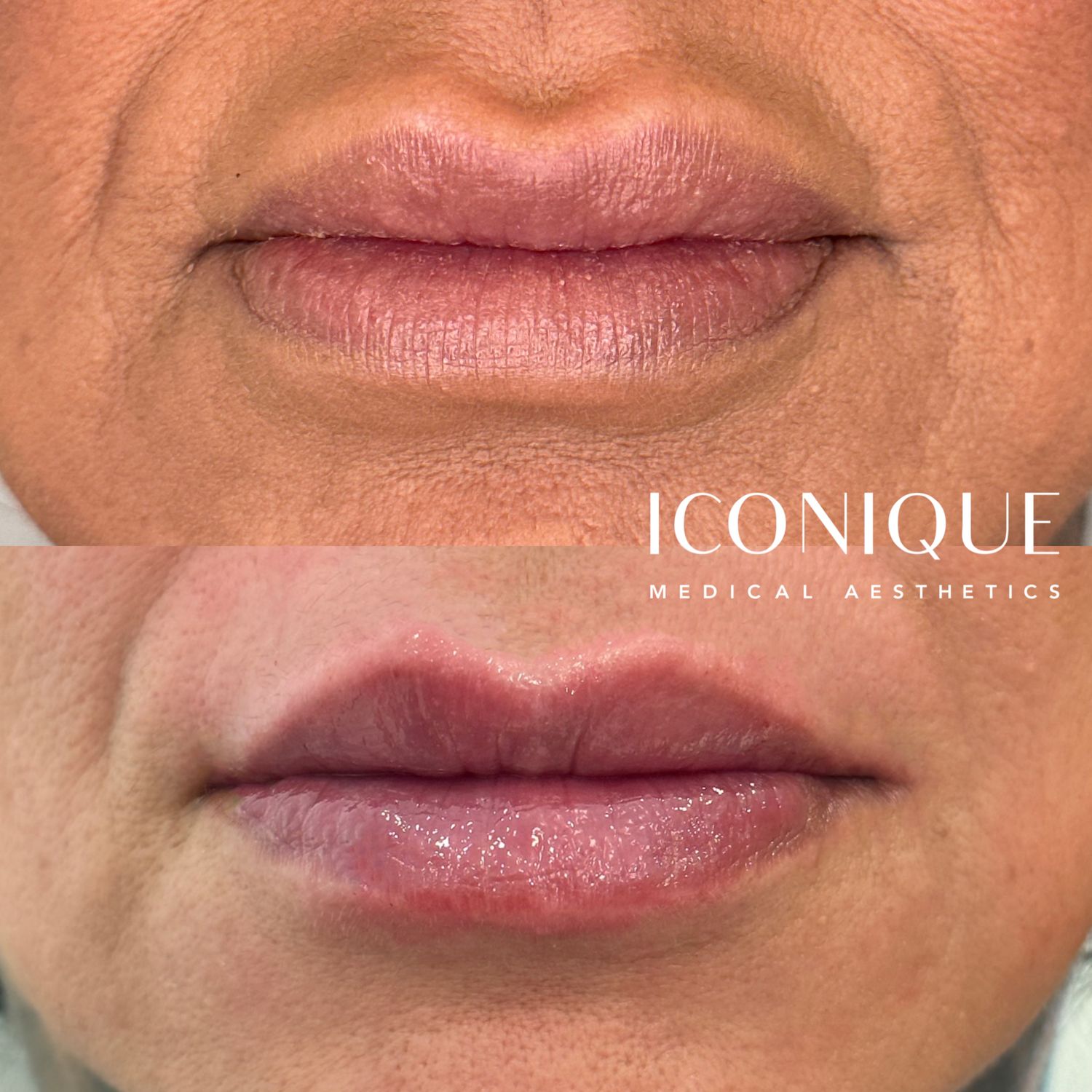 Lip Reset Before & After