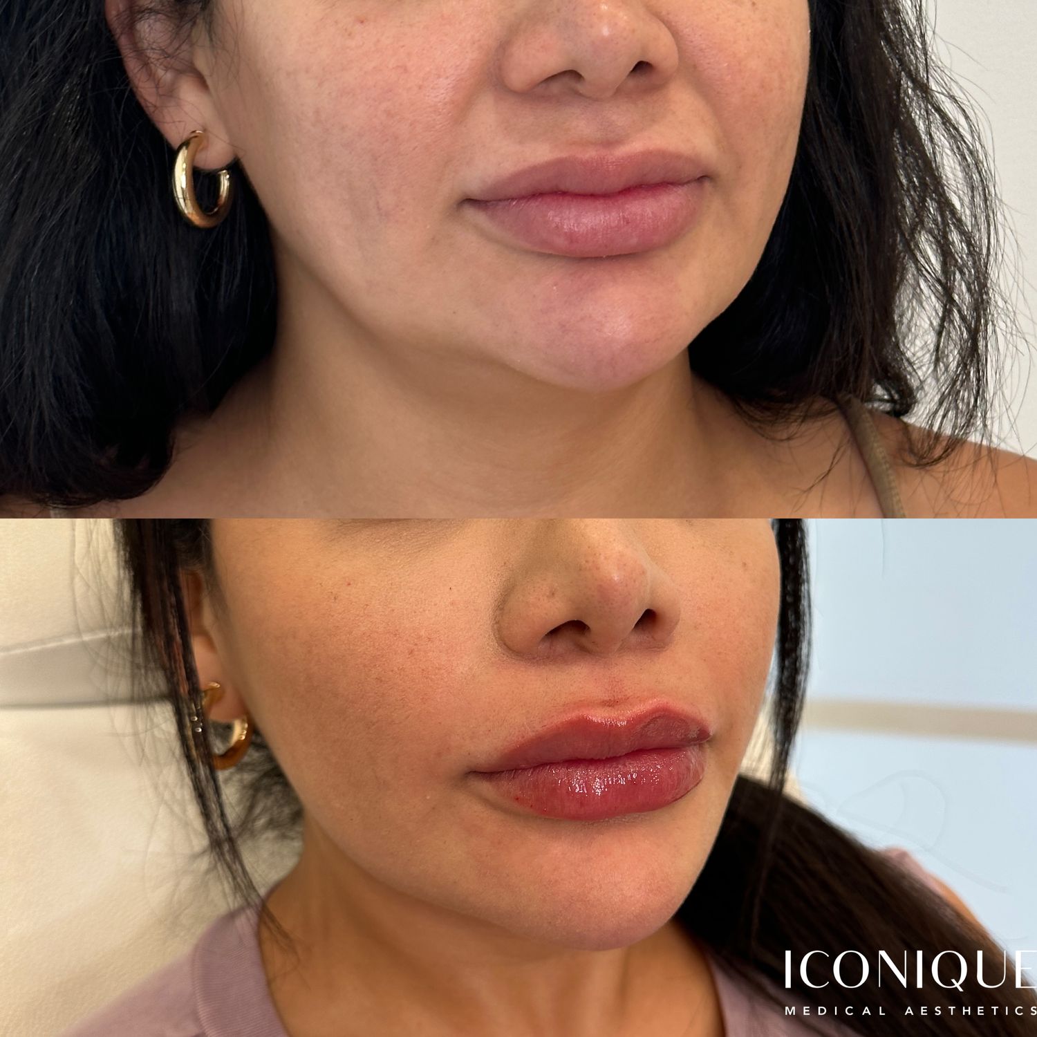 Lip Reset Before & After