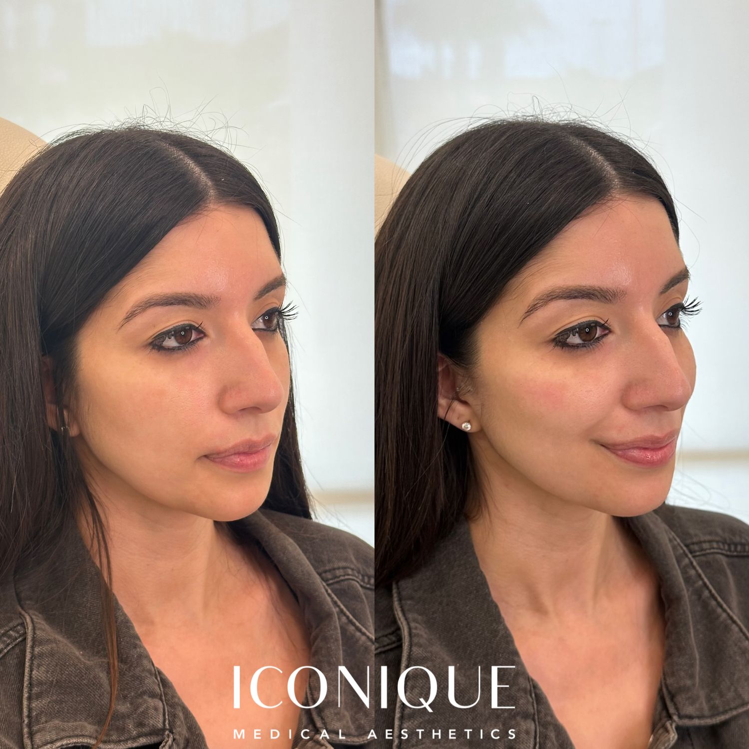 Cheek Filler Before & After