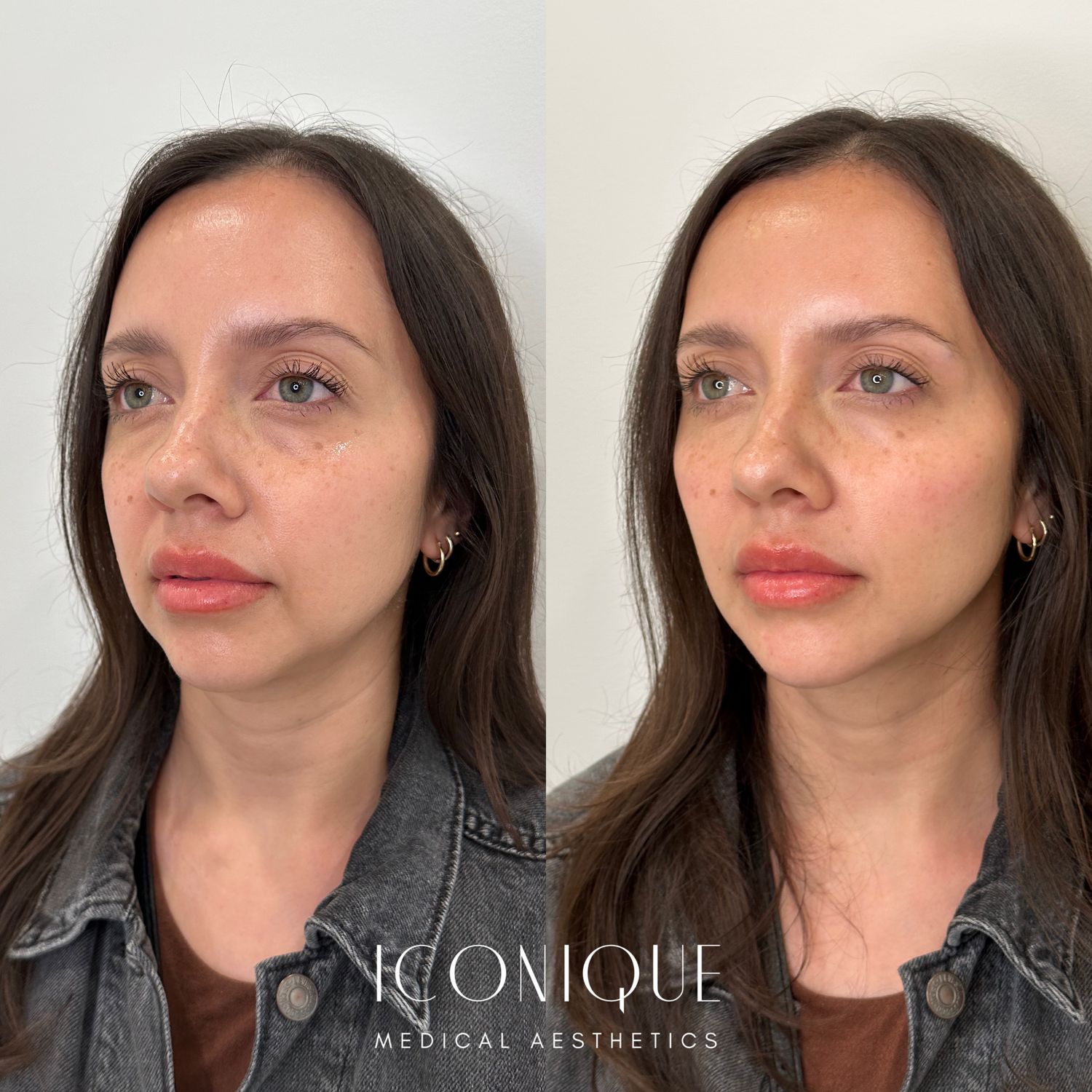 Cheek Filler Before & After