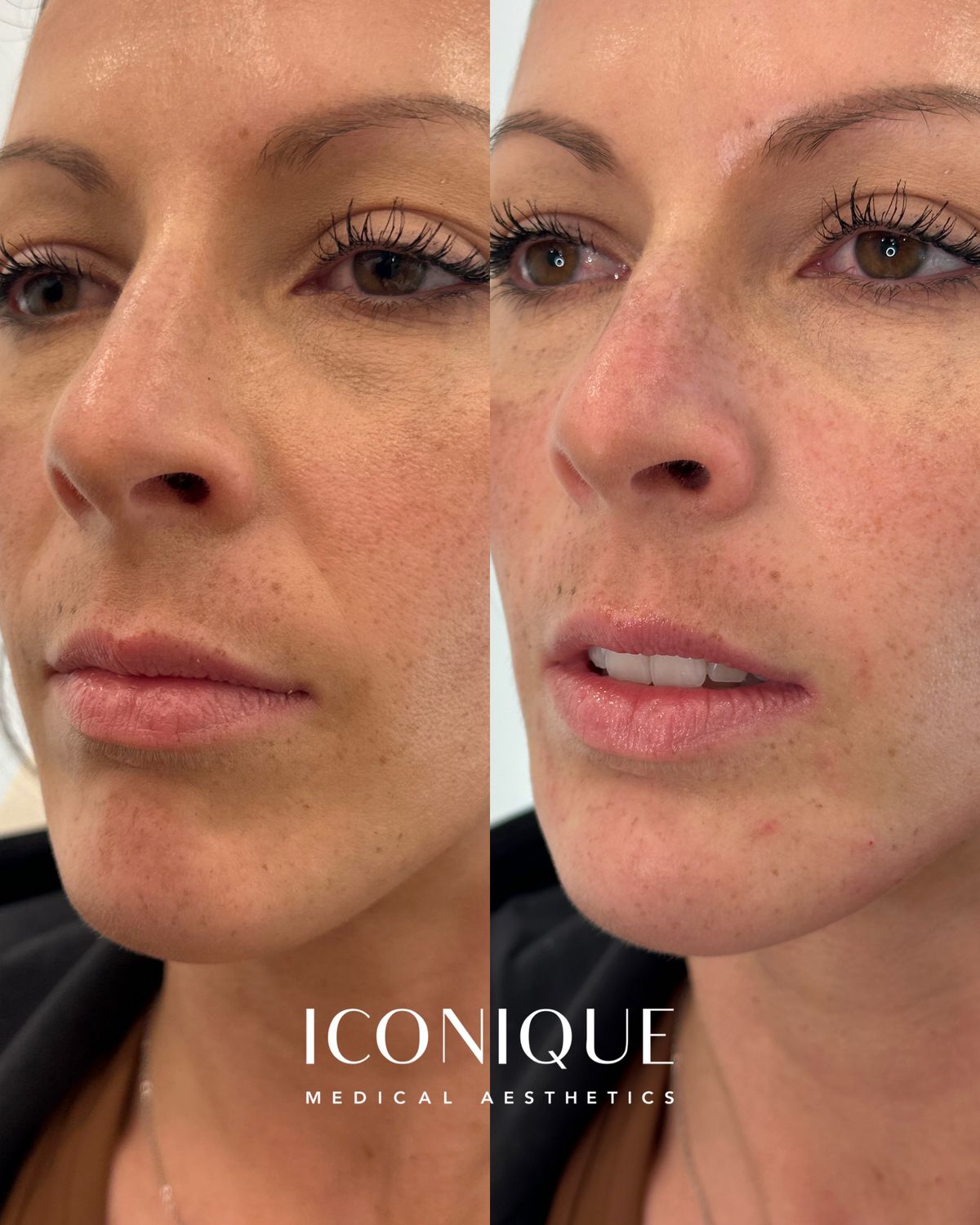 Smile Lines Before & After