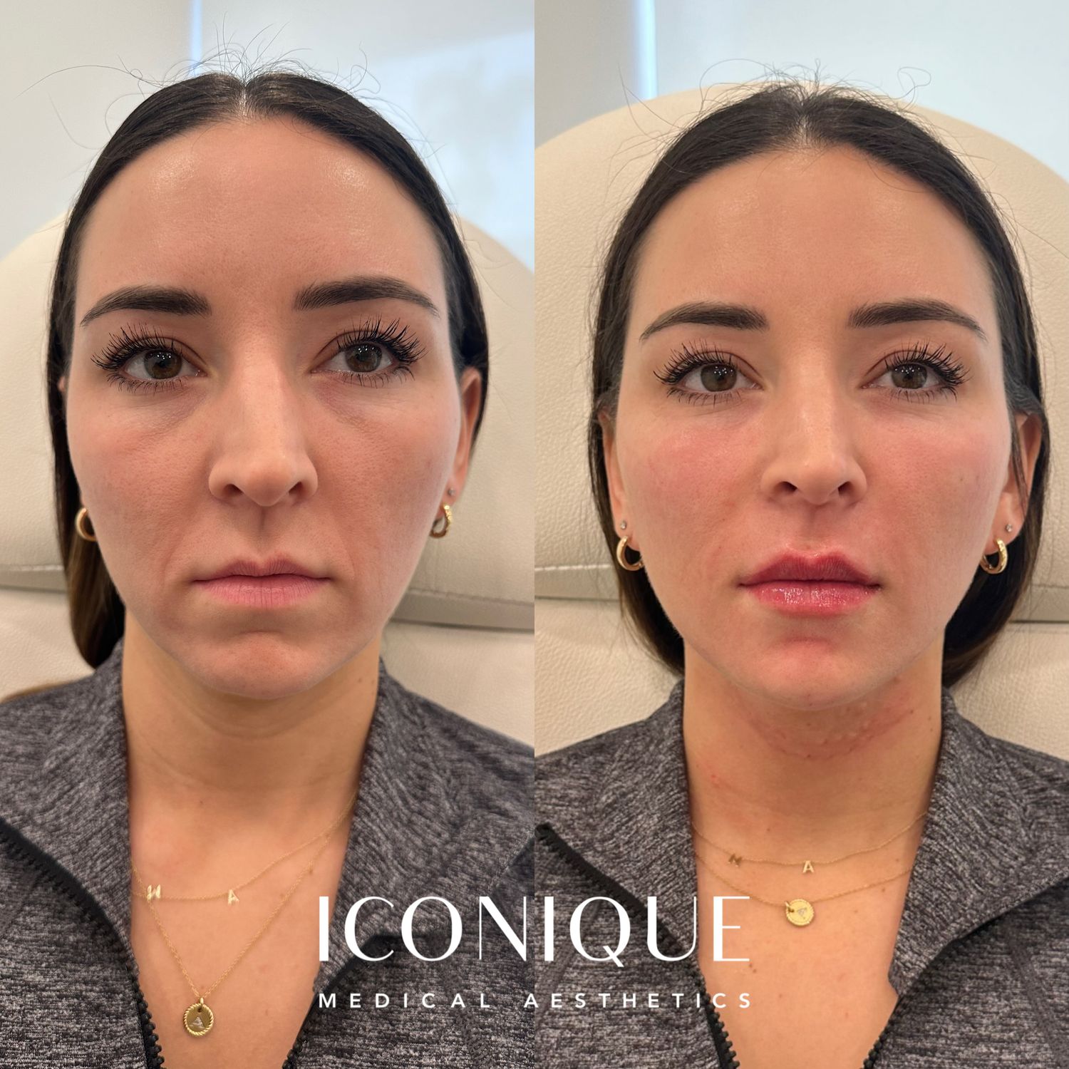 Facial Balancing Before & After