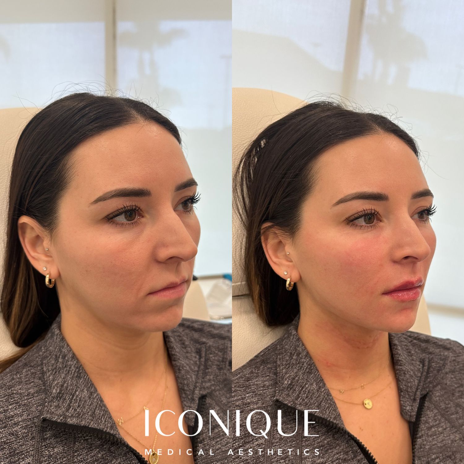 Facial Balancing Before & After