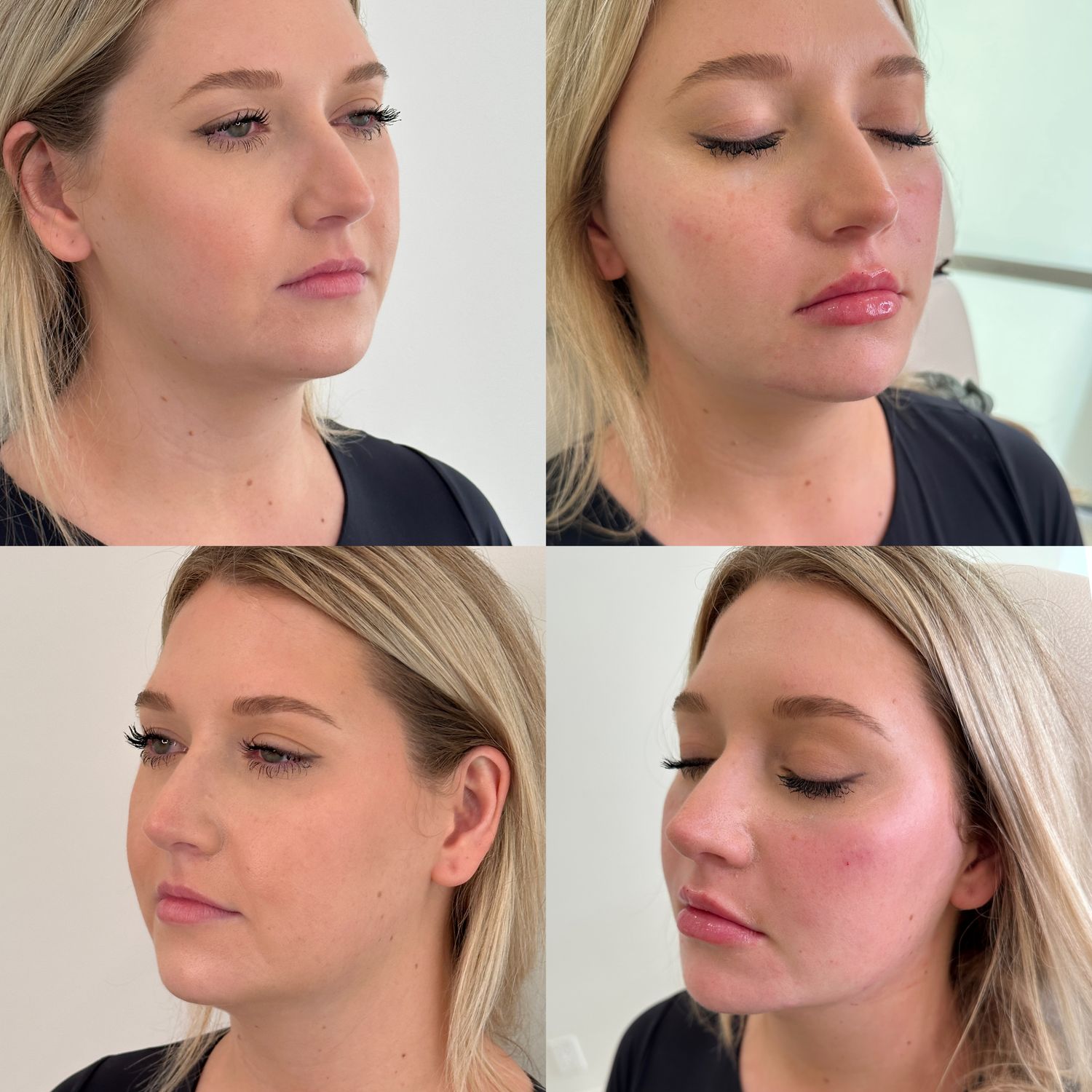 Facial Balancing Before & After