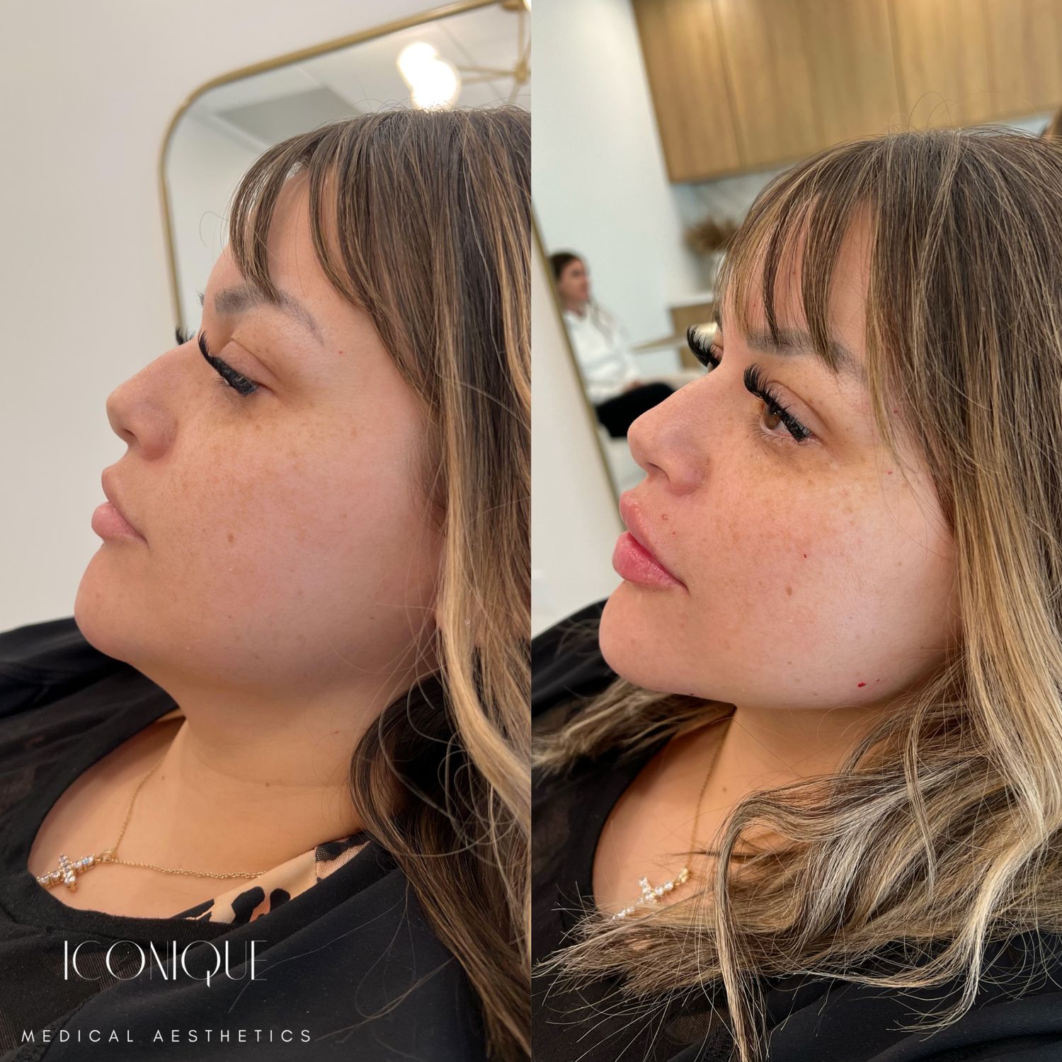 Facial Balancing Before & After