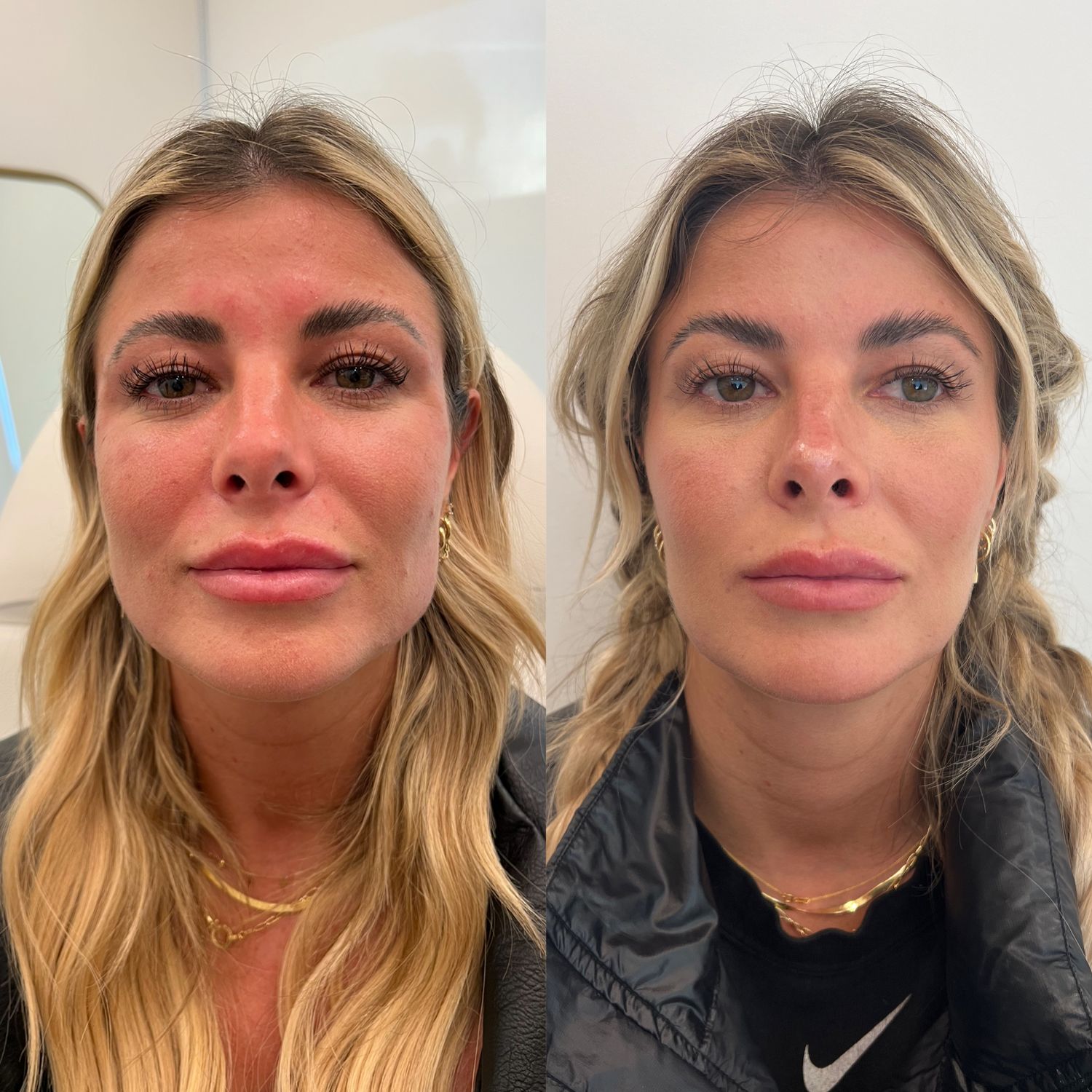 Botox Before & After