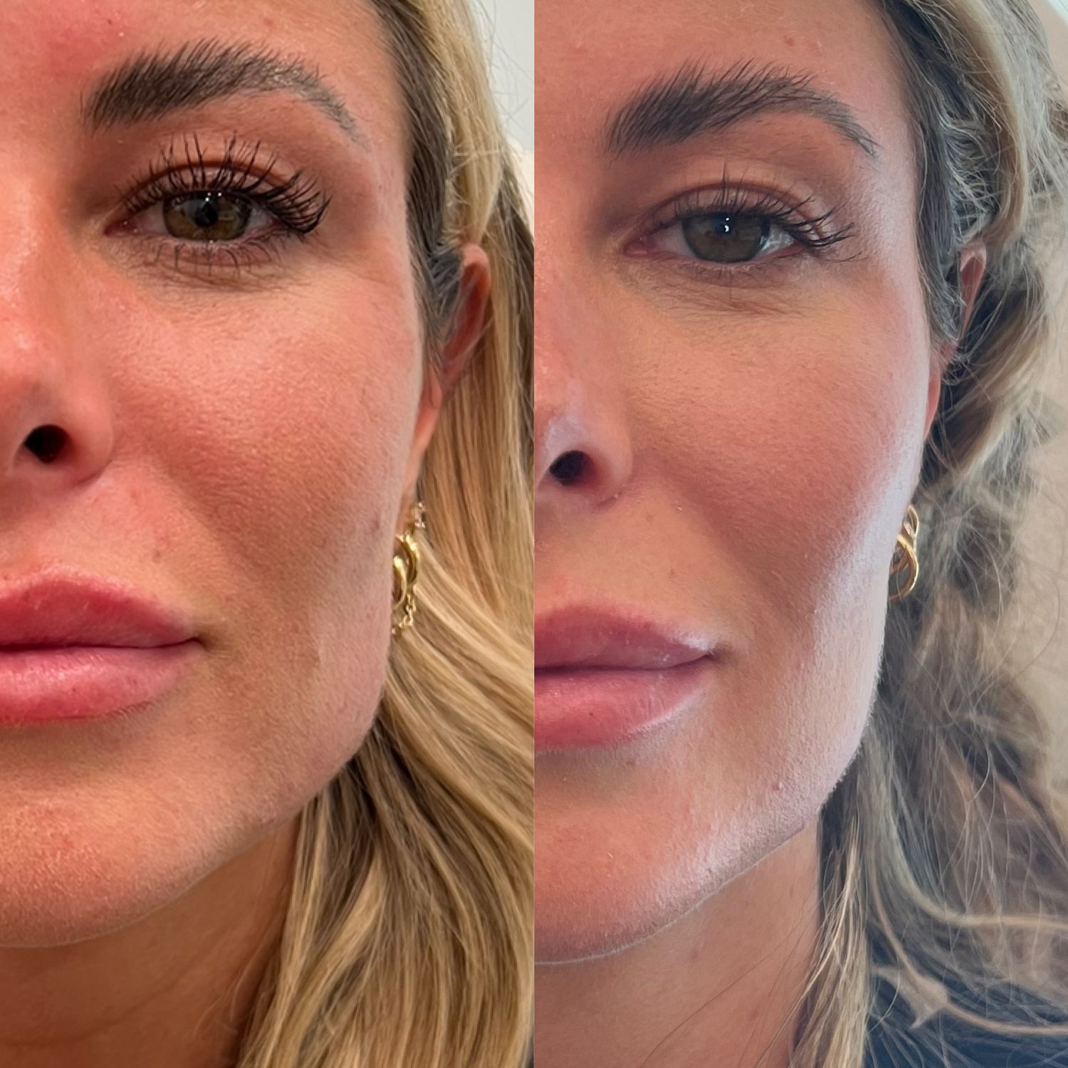 Botox Before & After