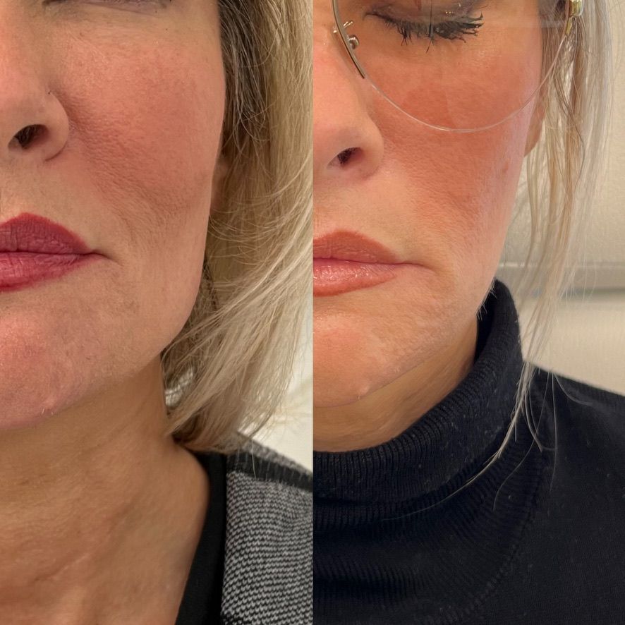 Botox Before & After