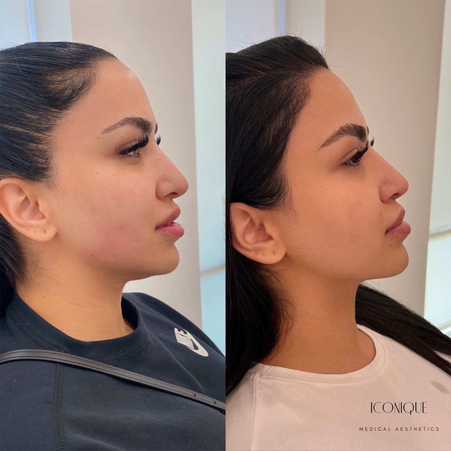 Kybella Before & After