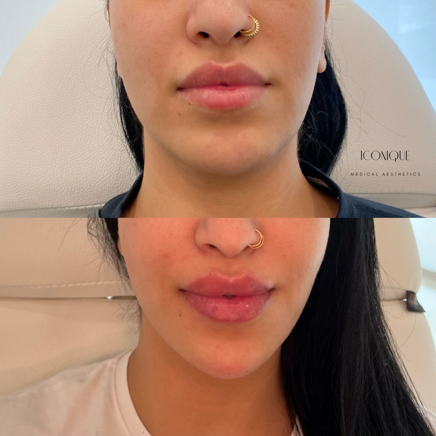 Kybella Before & After