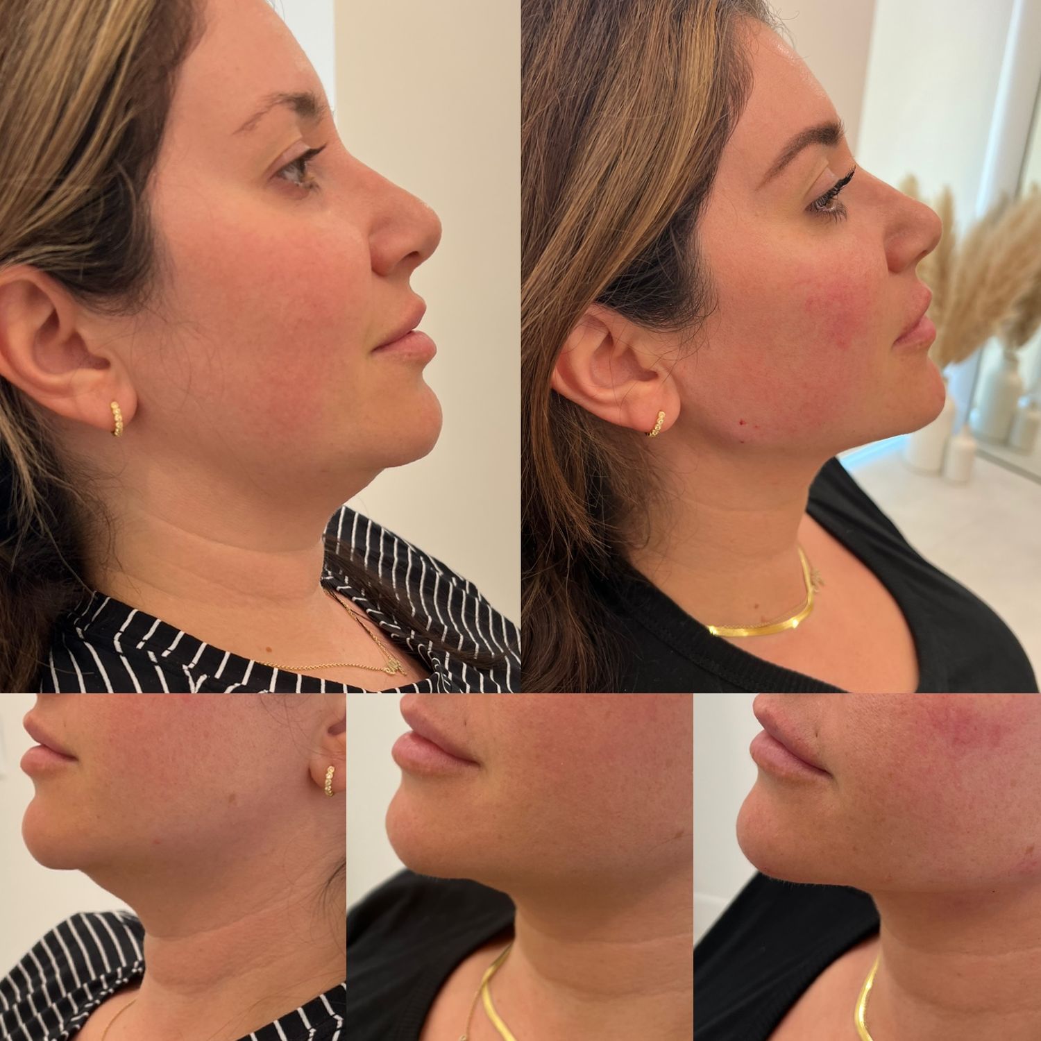 Kybella Before & After