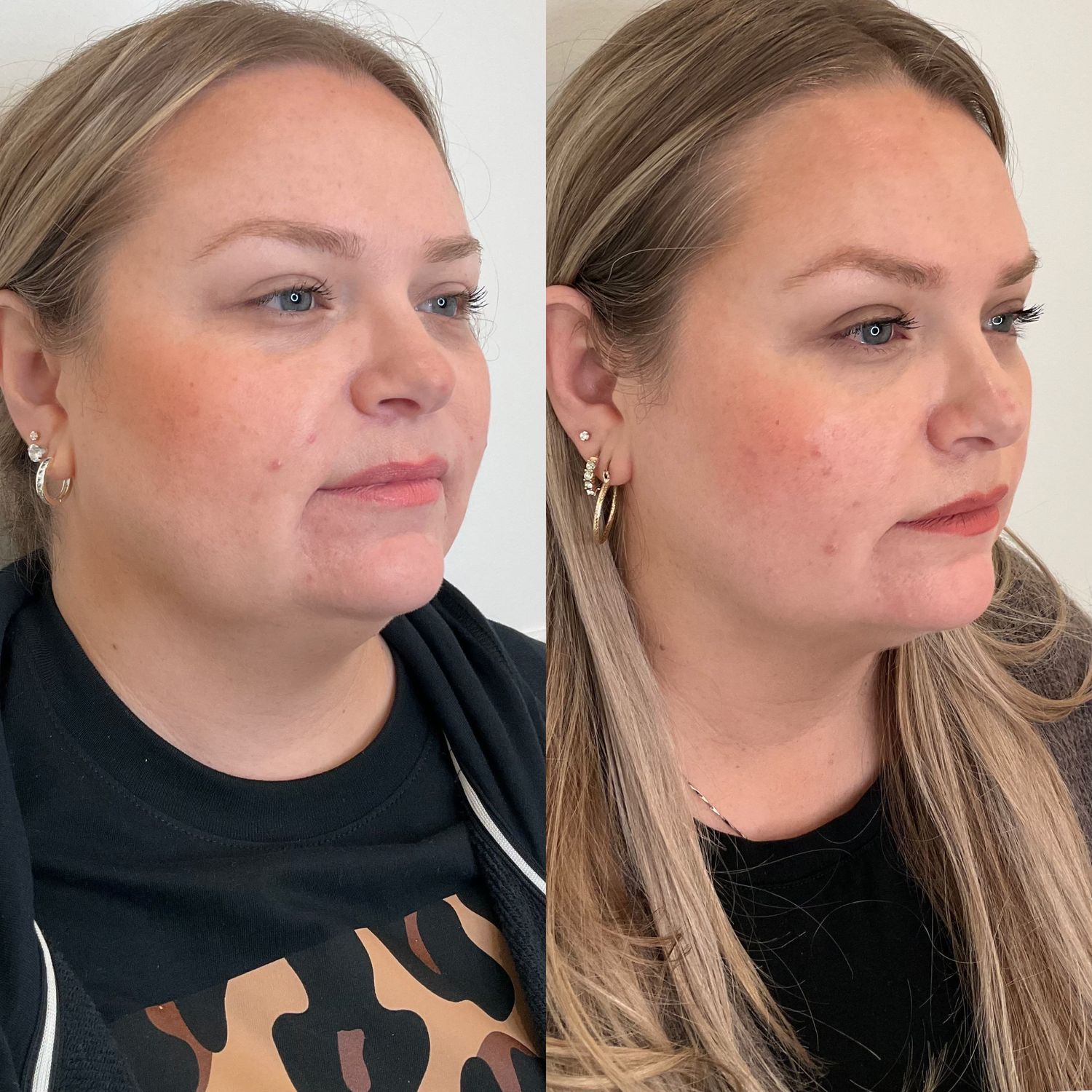 Kybella Before & After