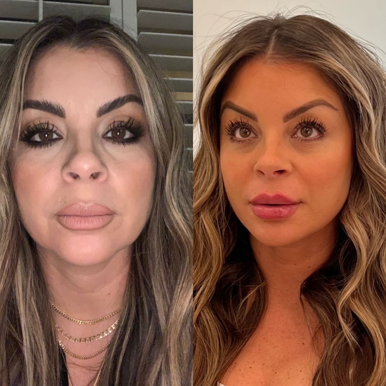 Kybella Before & After