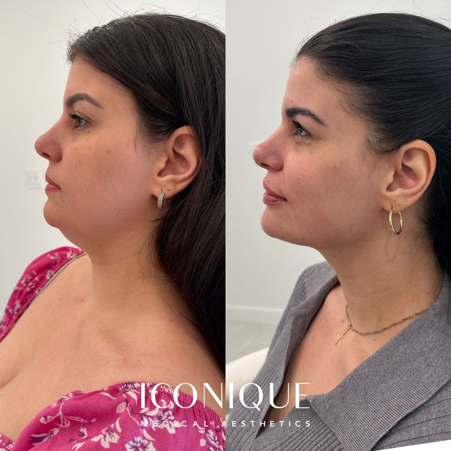 Kybella Before & After