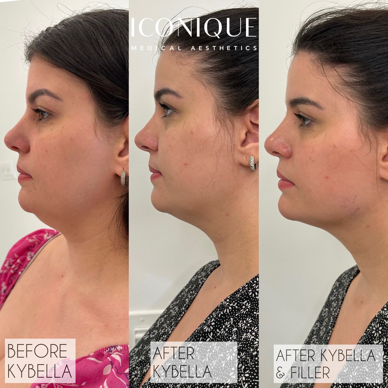 Kybella Before & After
