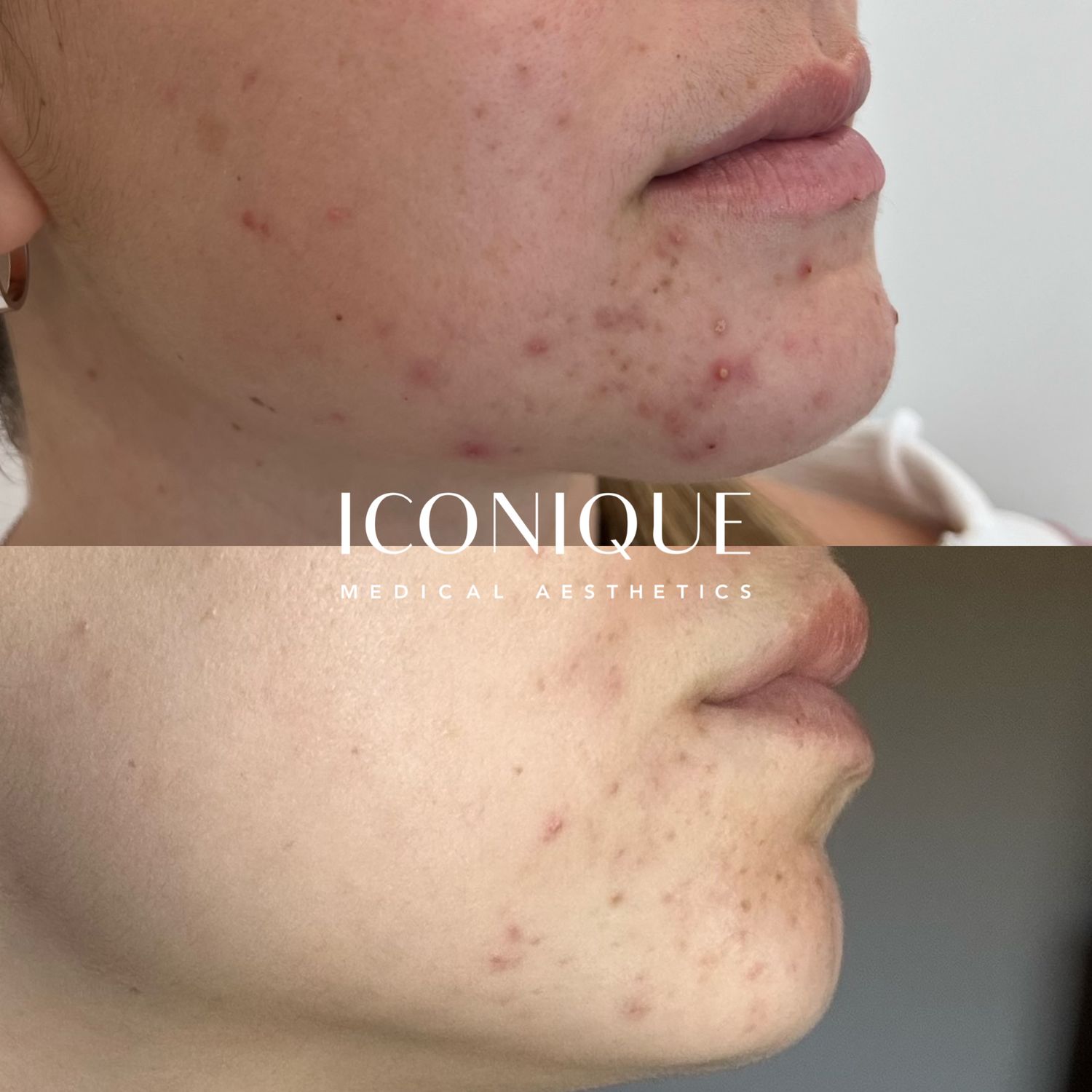 Skin Resurfacing Before & After