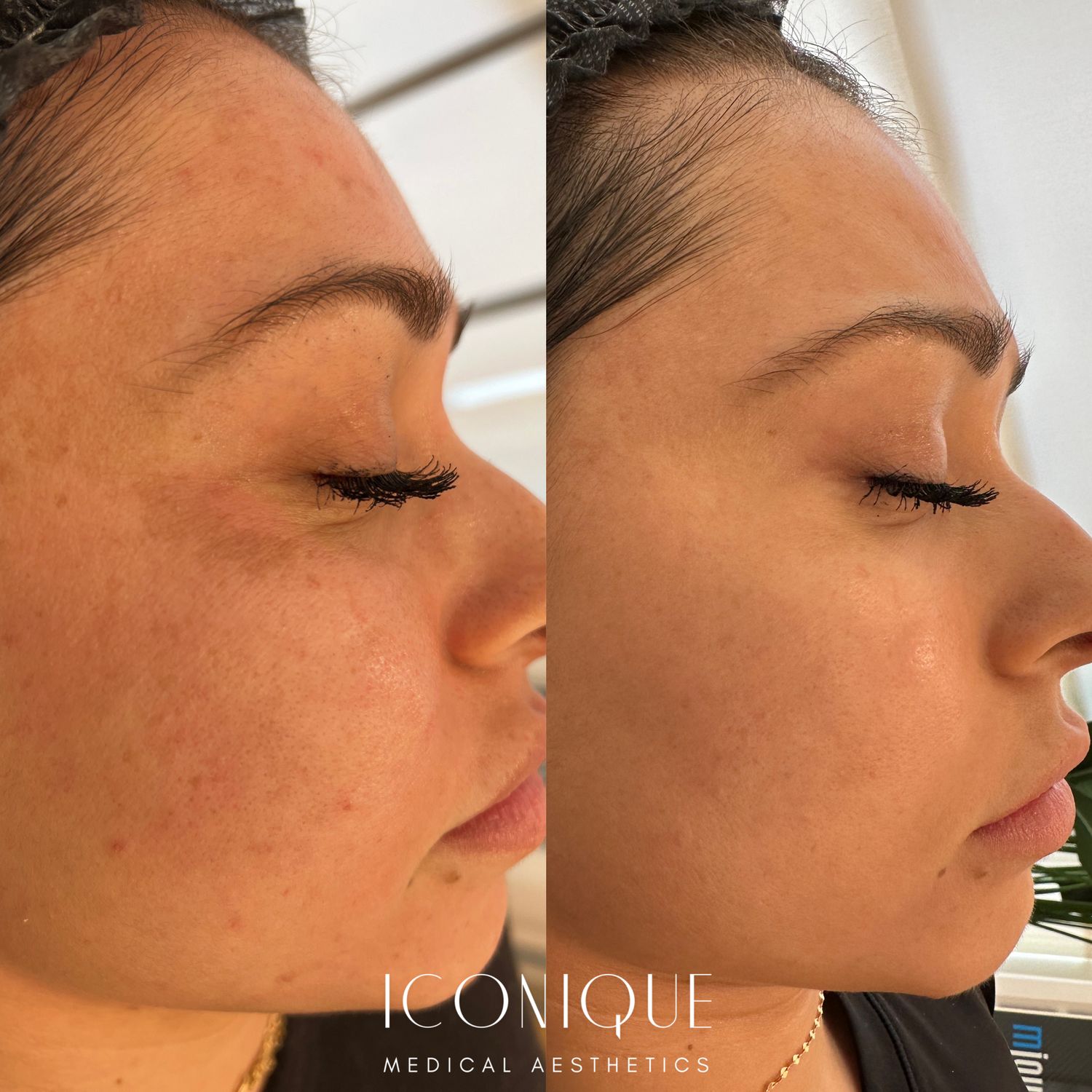 Skin Resurfacing Before & After