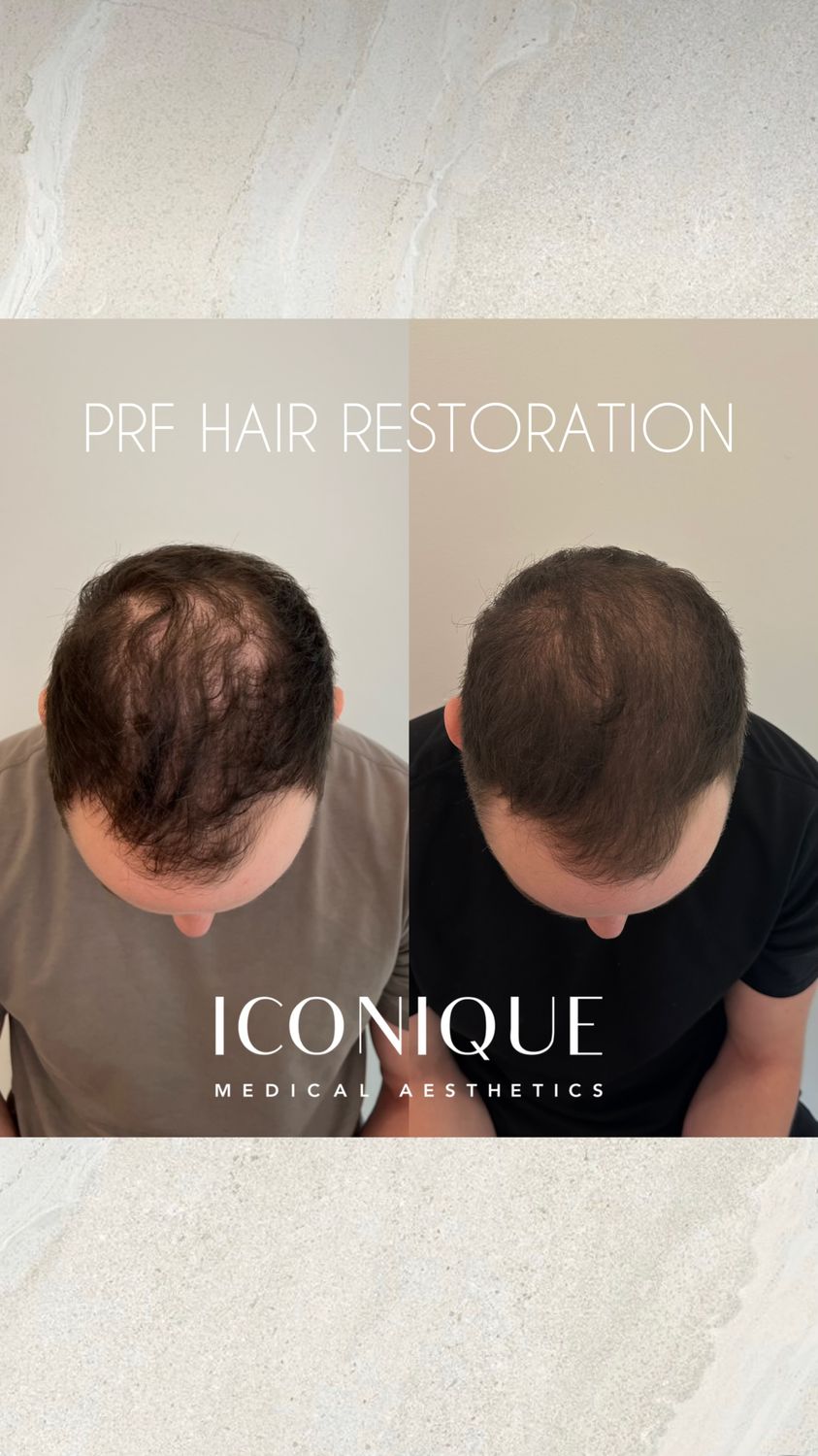 PRF Hair Restoration Before & After