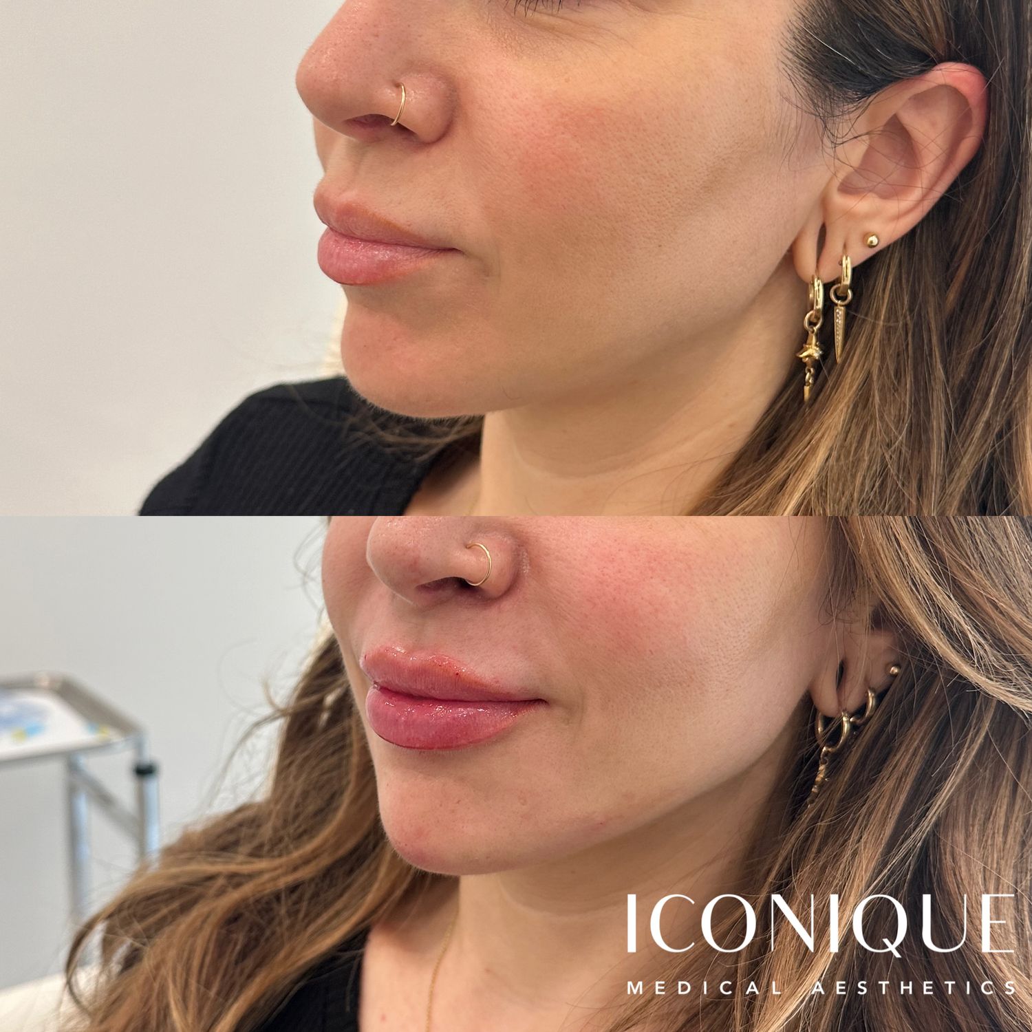 Lips + Chin Filler Before & After