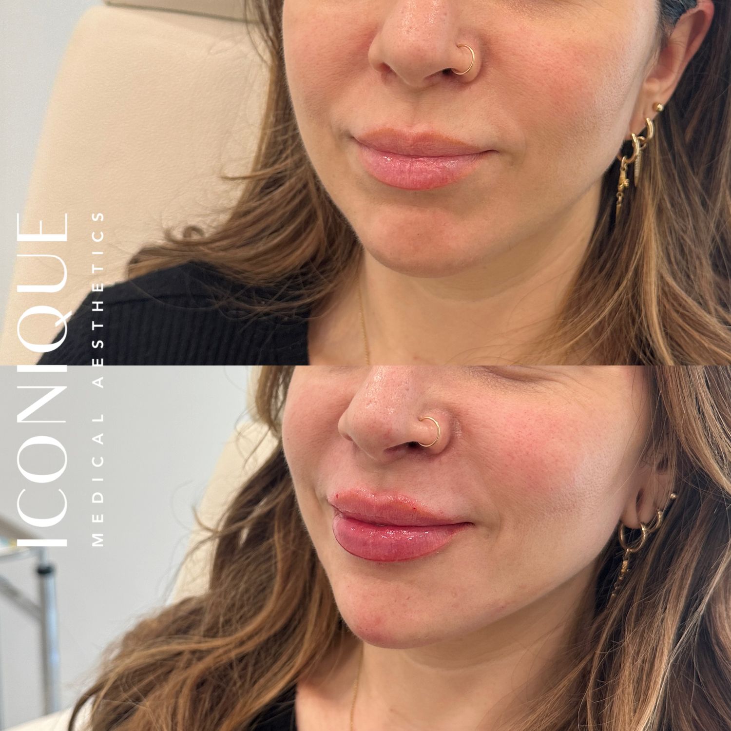 Lips + Chin Filler Before & After