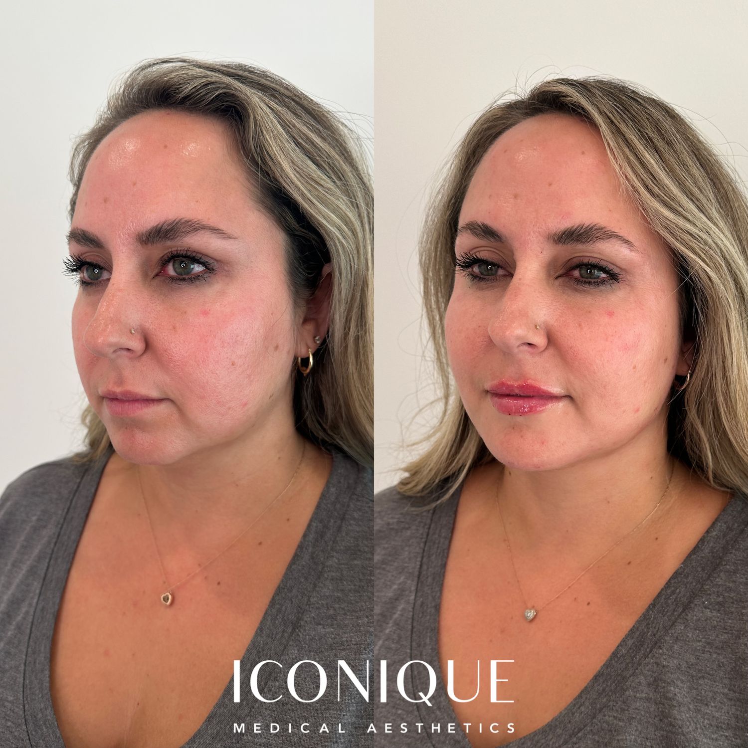 Lips + Chin Filler Before & After