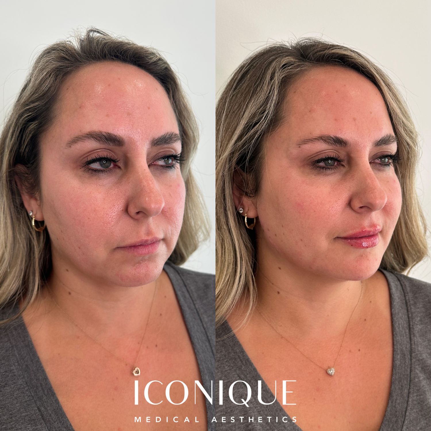 Lips + Chin Filler Before & After