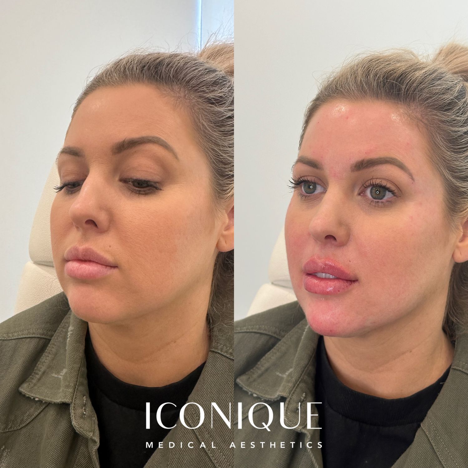 Lips + Chin Filler Before & After