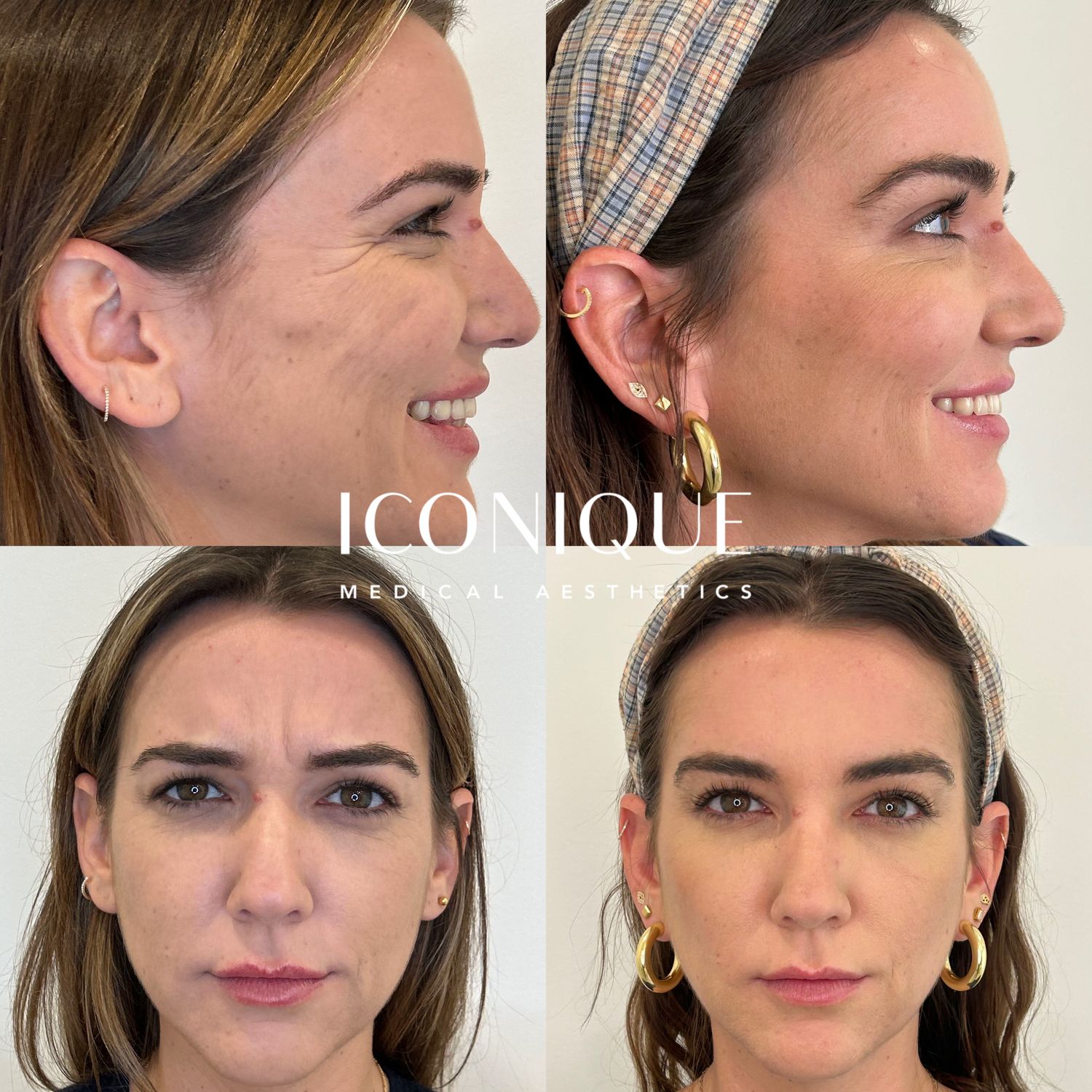 Lips + Chin Filler Before & After