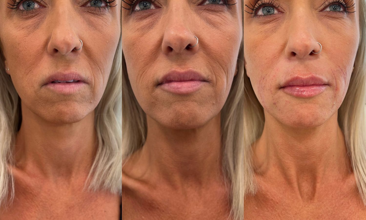 Lips + Chin Filler Before & After