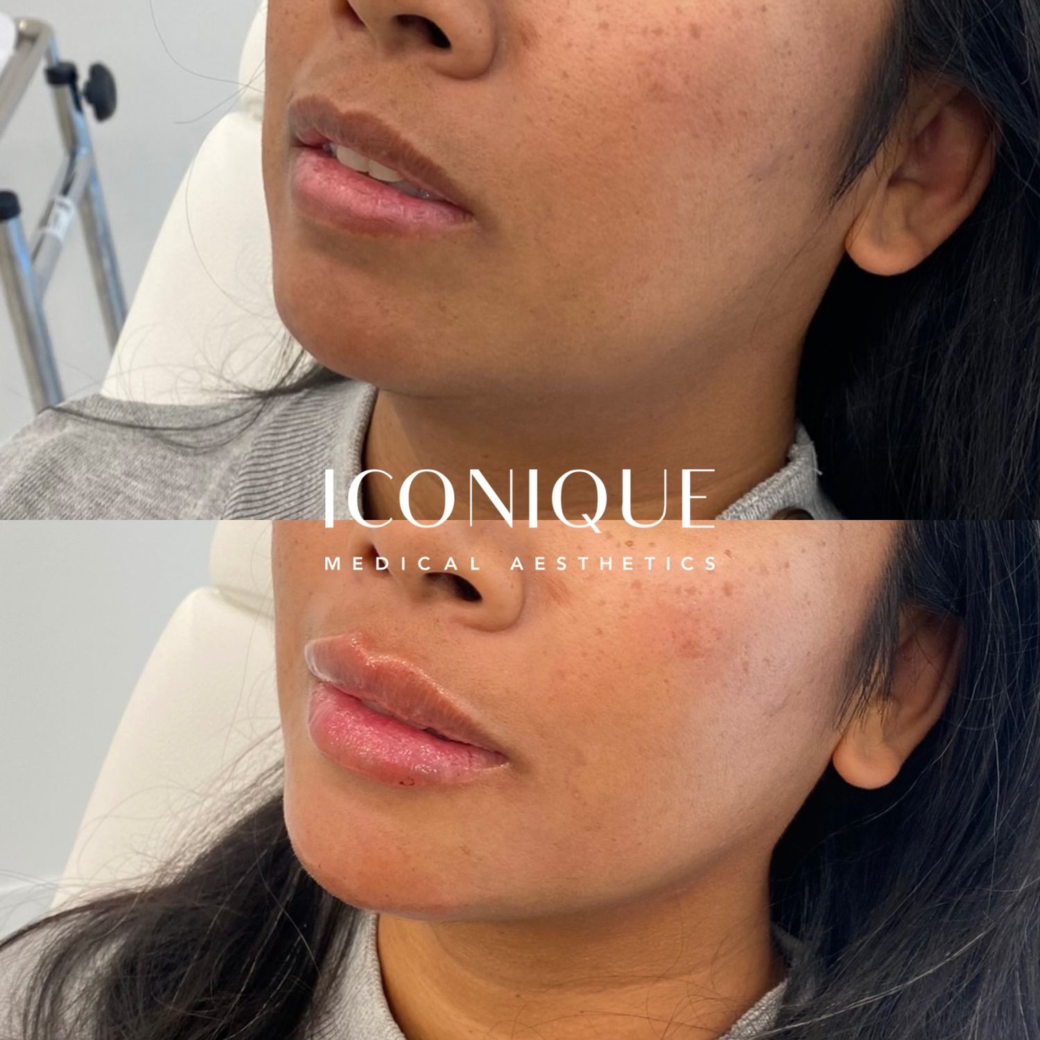 Lips + Chin Filler Before & After