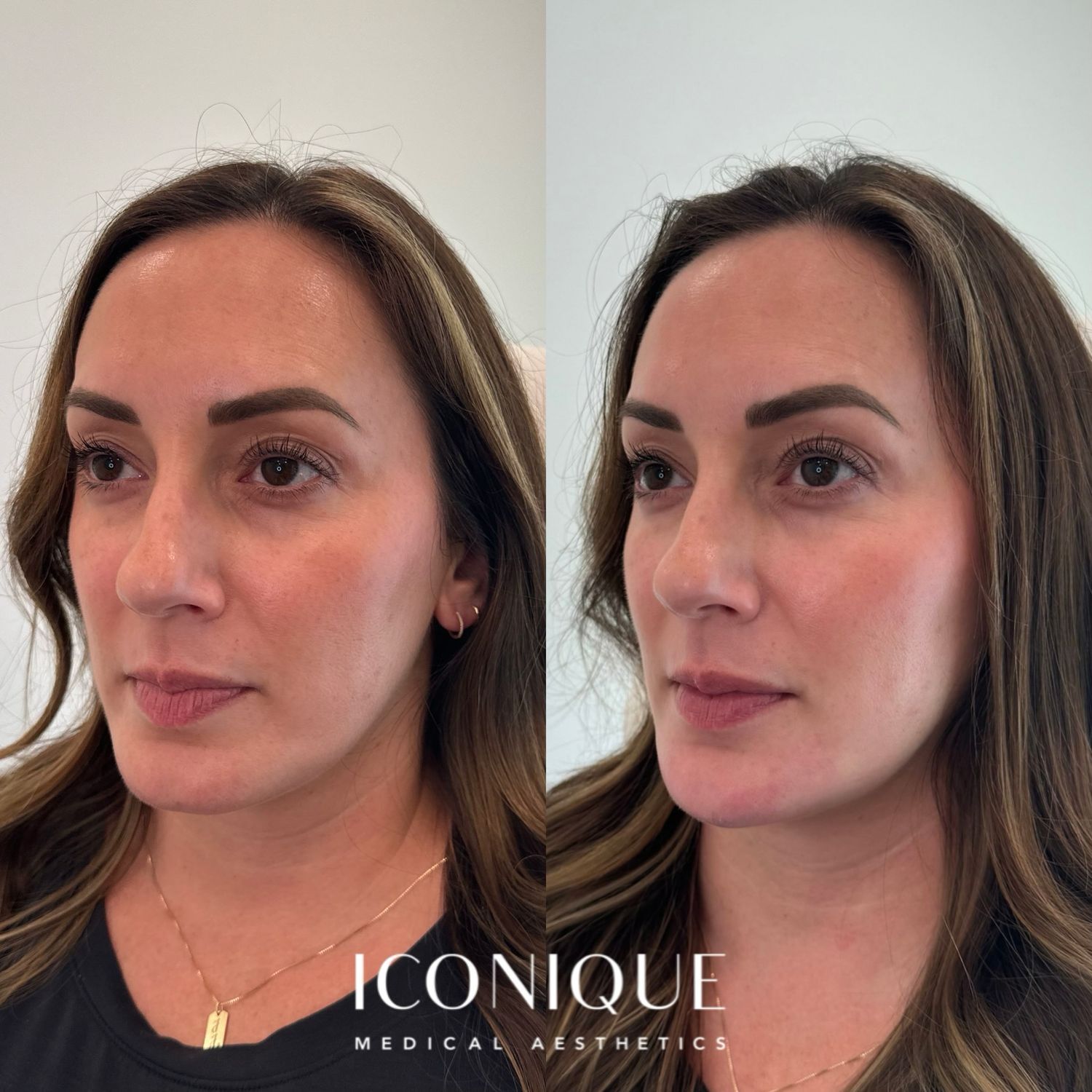 Lips + Chin Filler Before & After