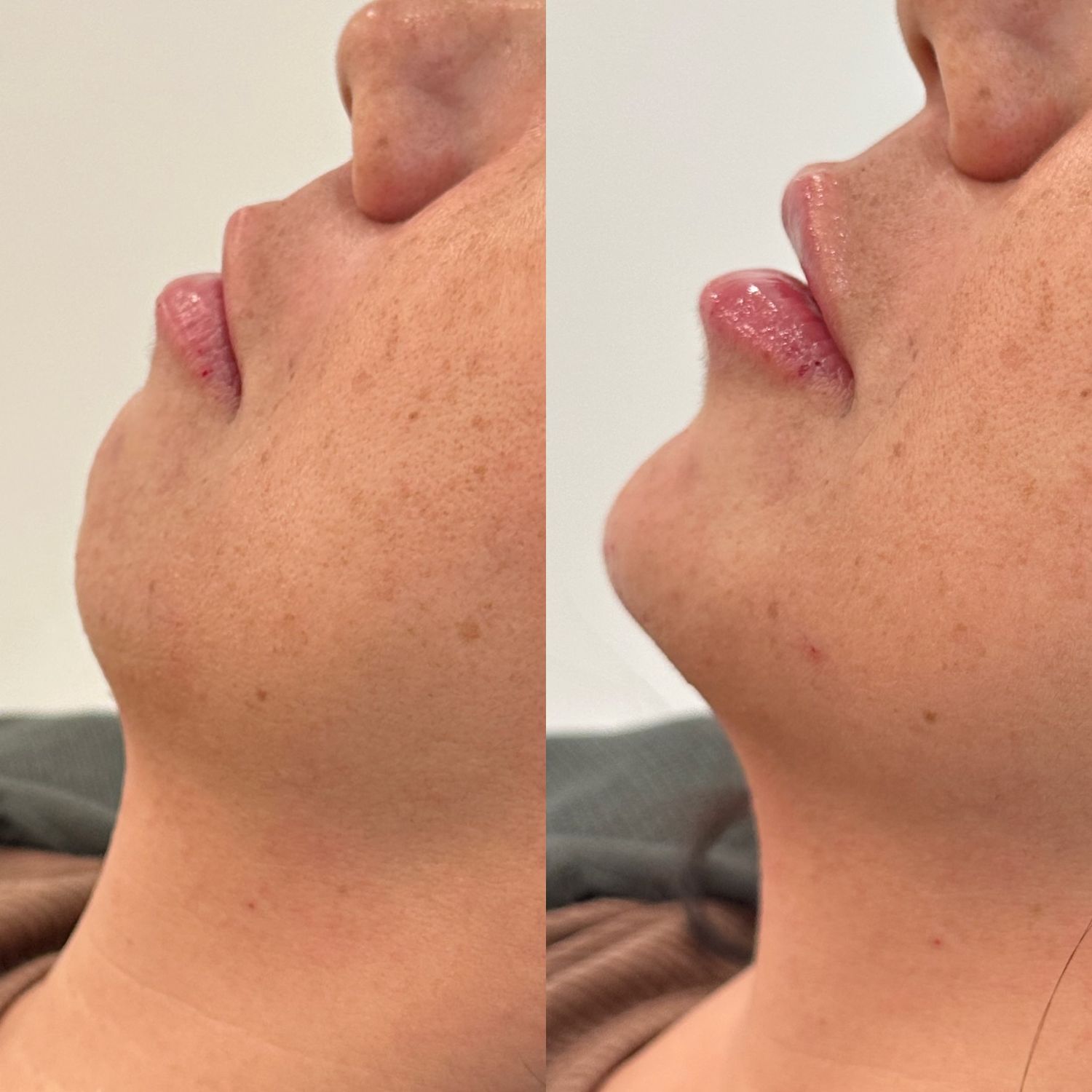 Lips + Chin Filler Before & After