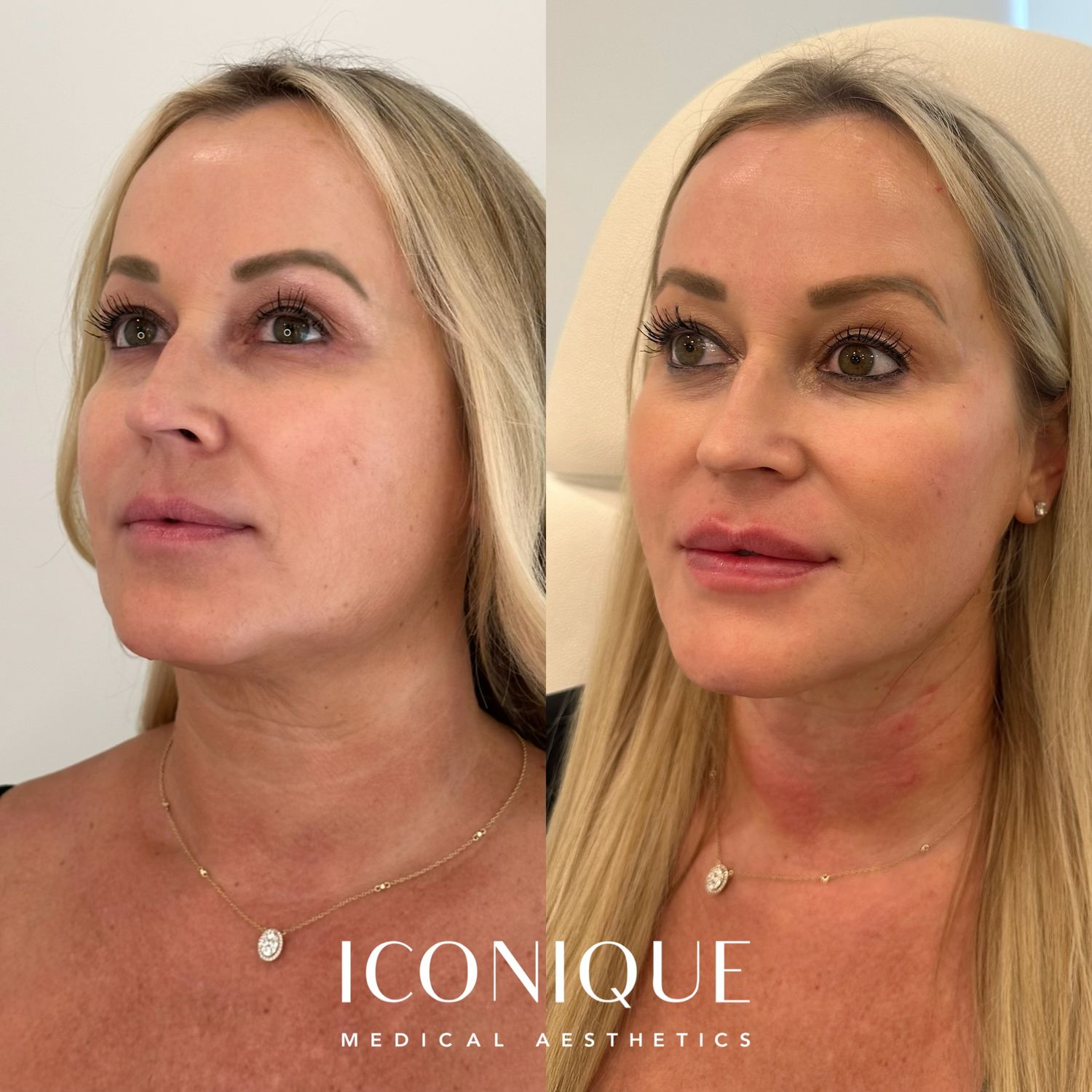Lips + Chin Filler Before & After