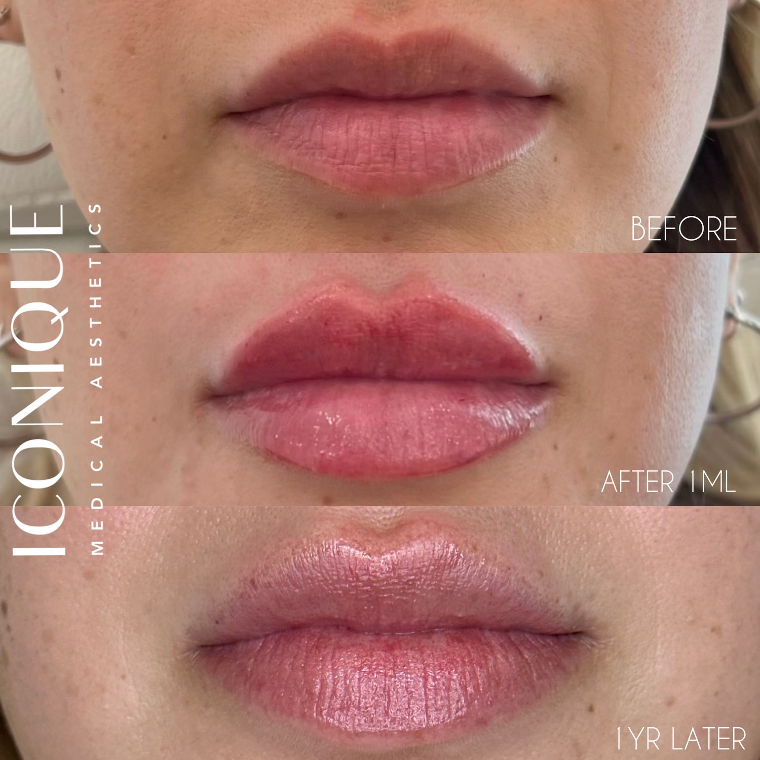 Lip Filler Before & After