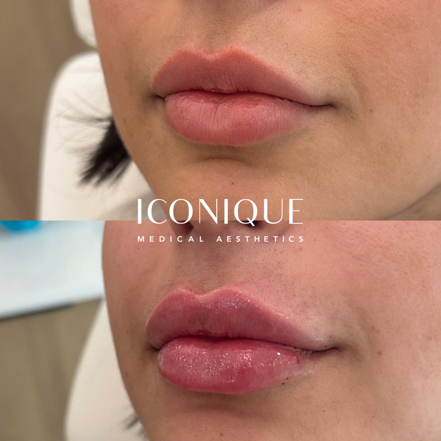 Lip Filler Before & After