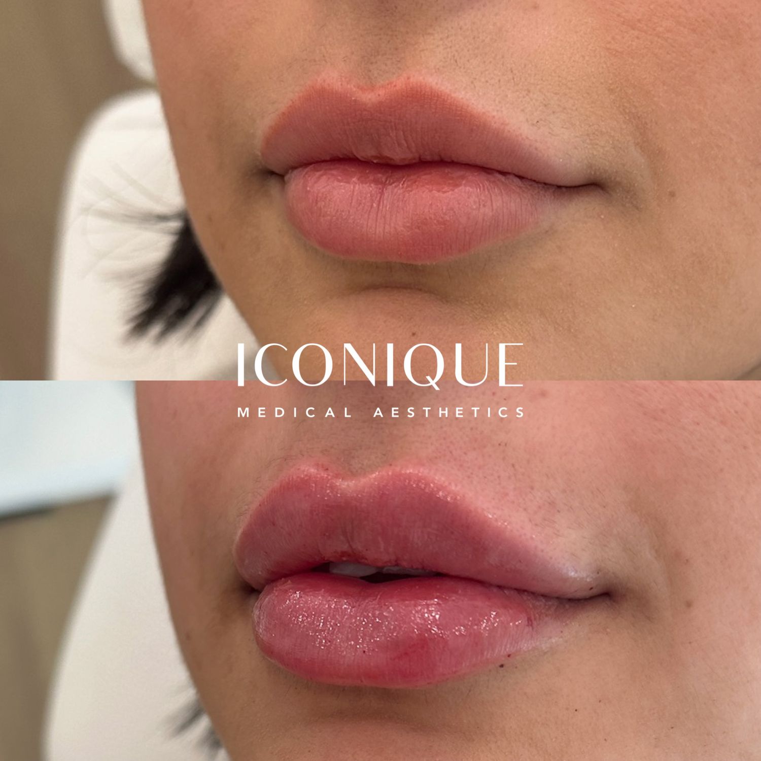 Lip Filler Before & After