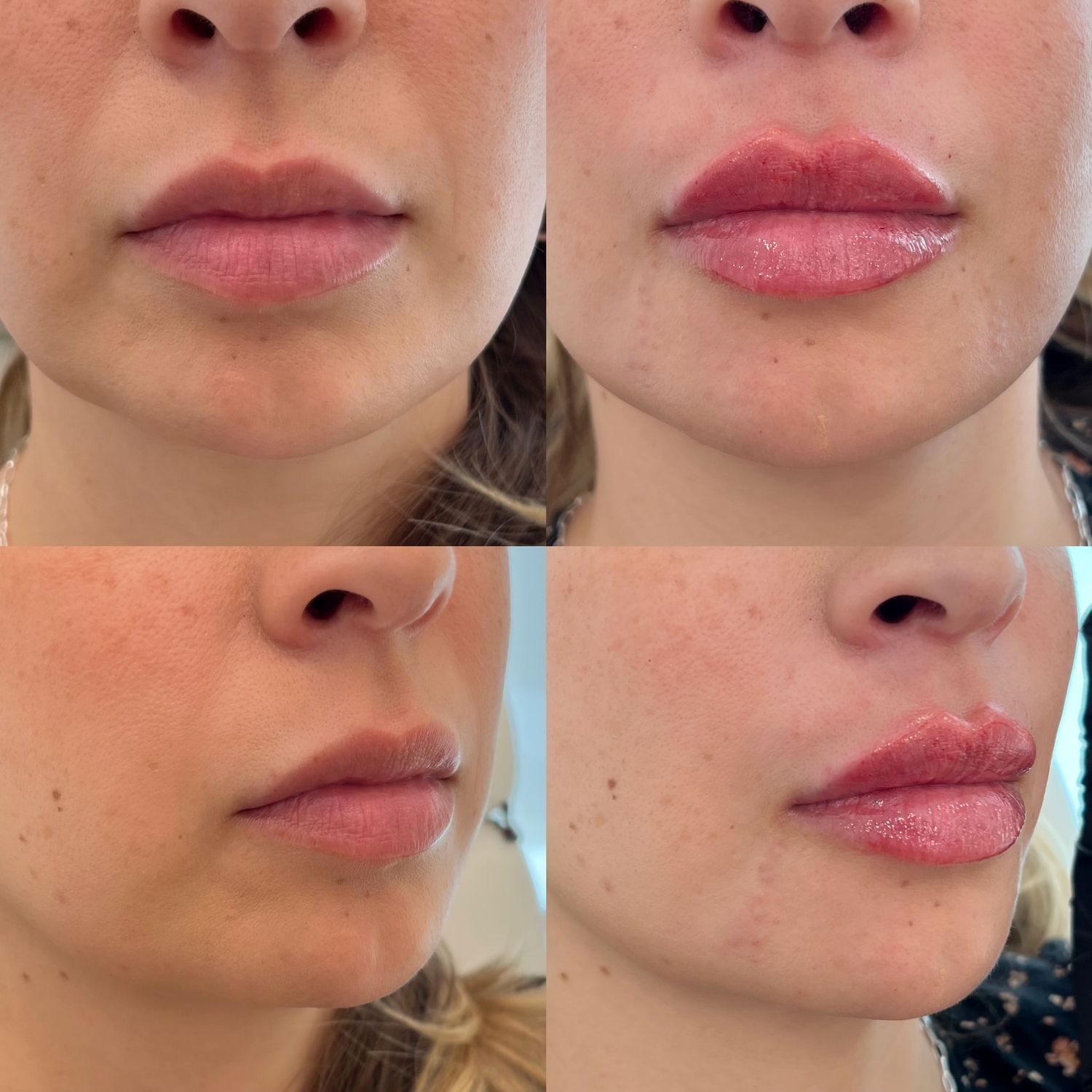 Lip Filler Before & After
