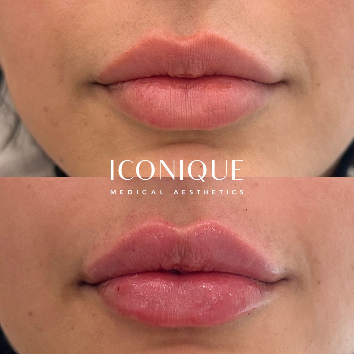Lip Filler Before & After
