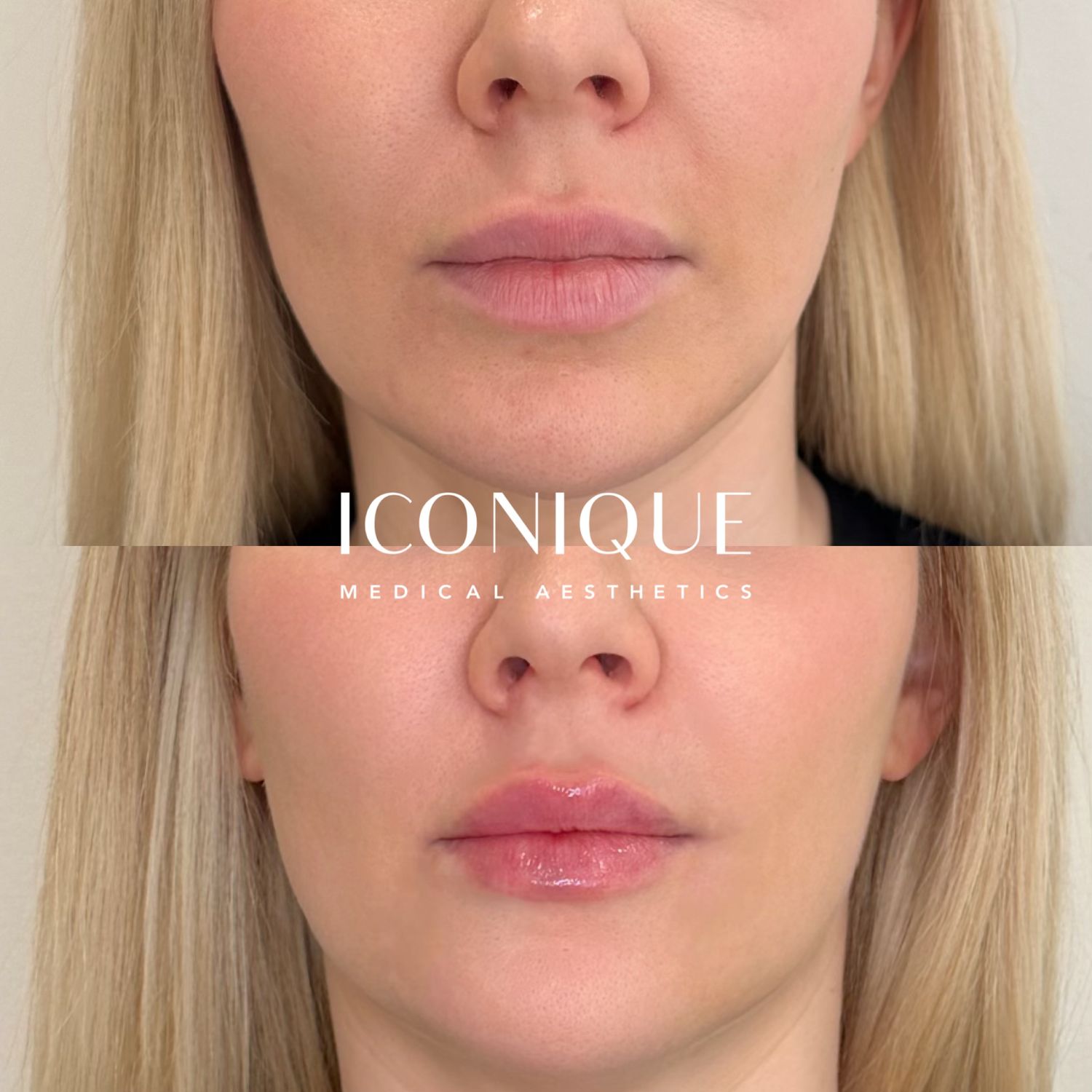 Lip Filler Before & After