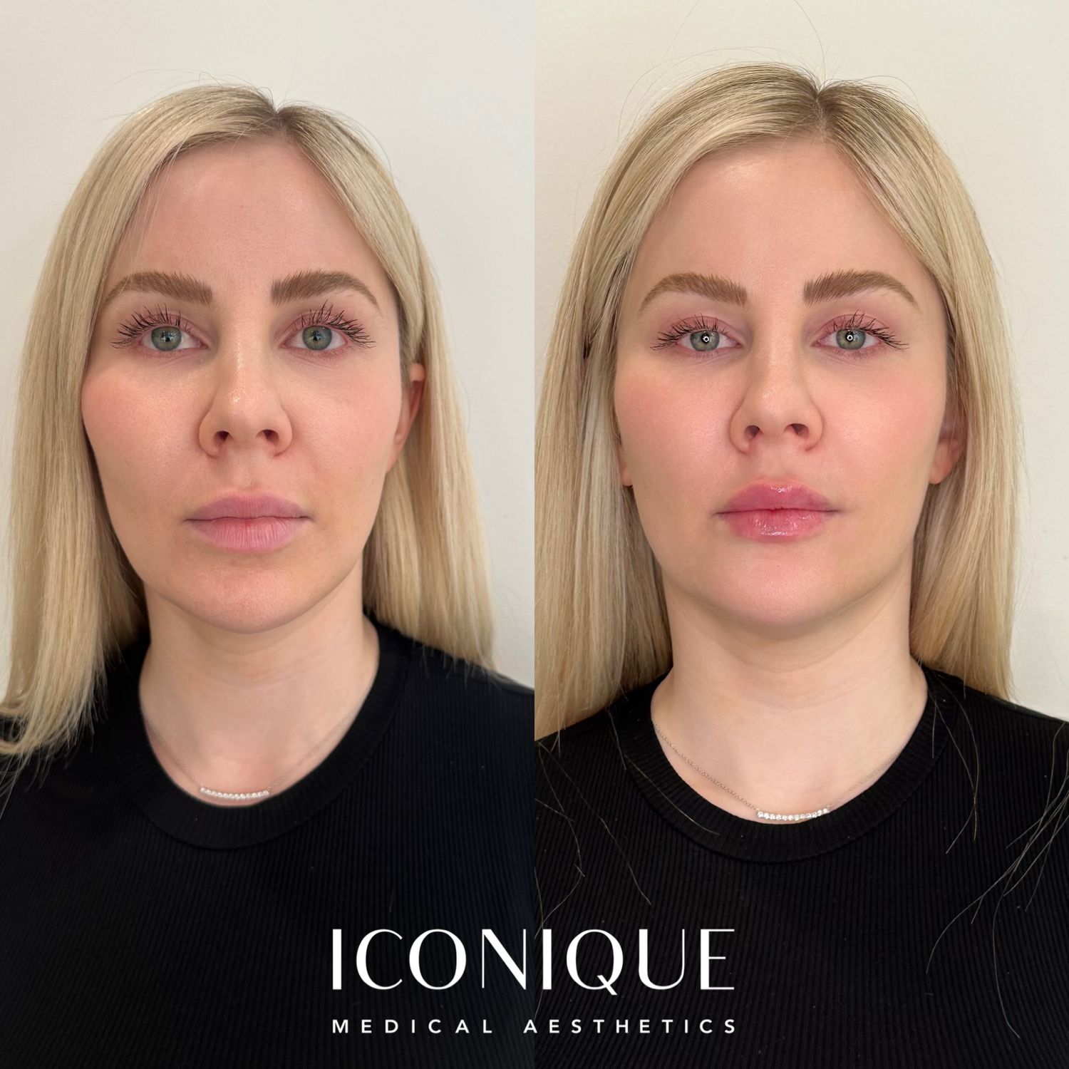 Lip Filler Before & After