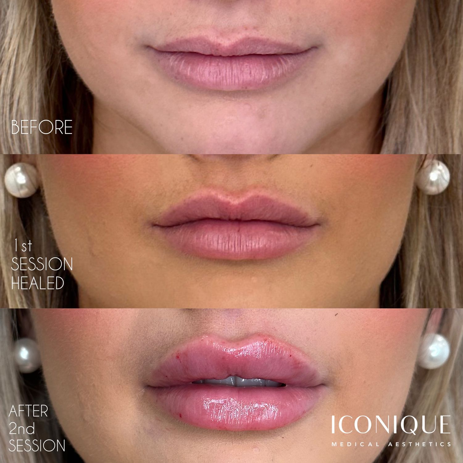 Lip Filler Before & After