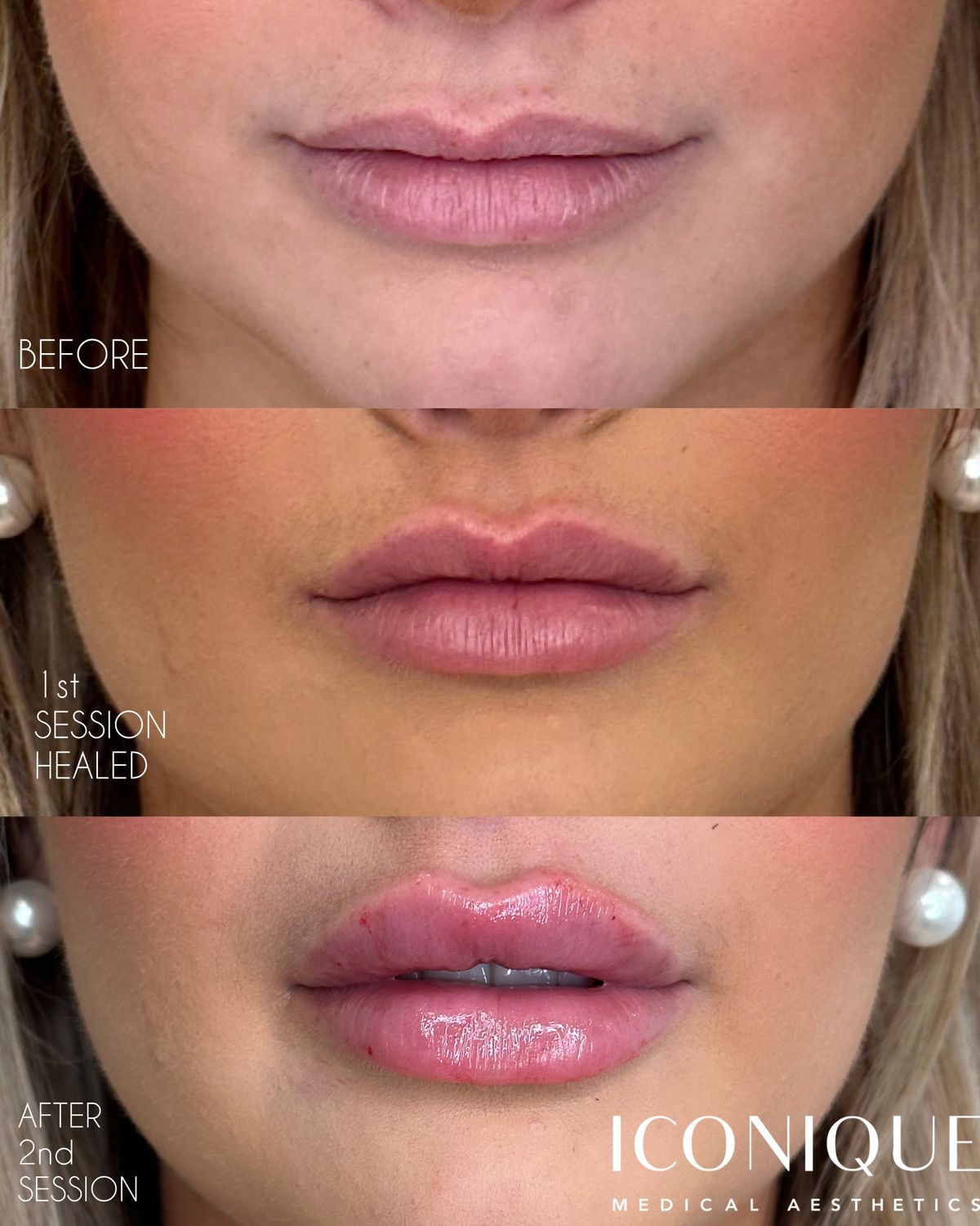 Lip Filler Before & After