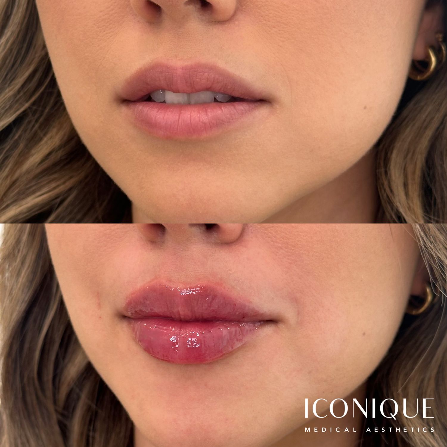 Lip Filler Before & After