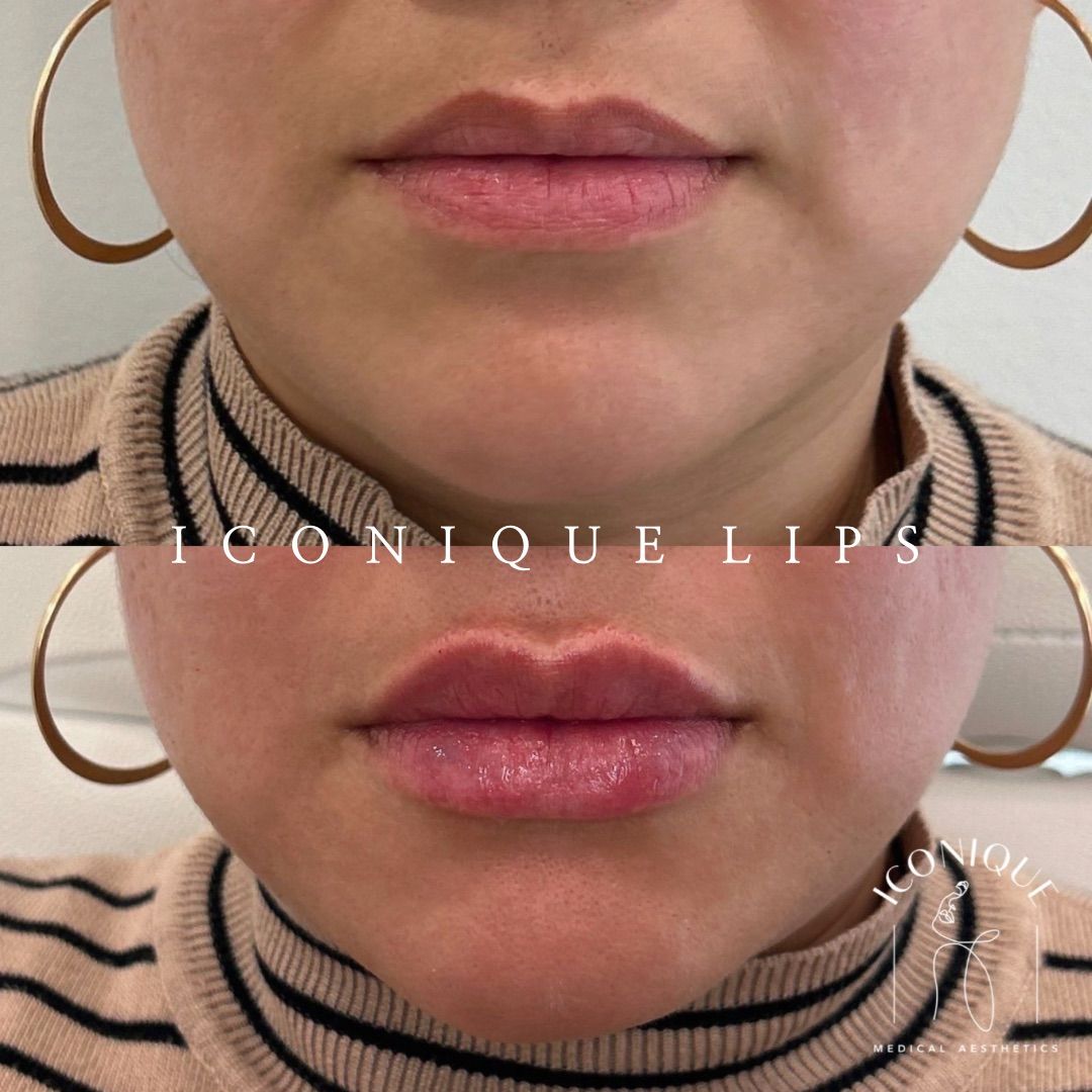 Lip Filler Before & After