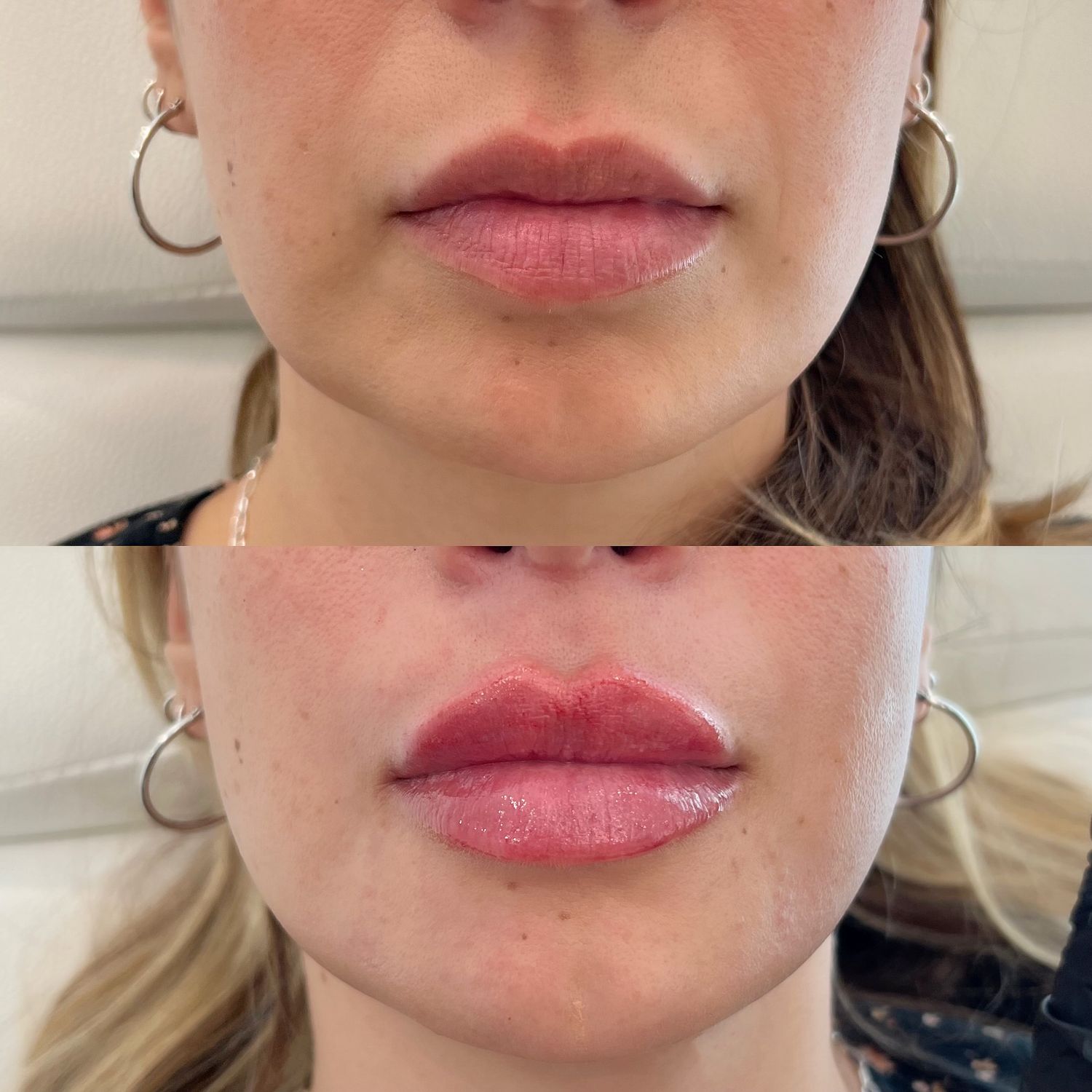Lip Filler Before & After