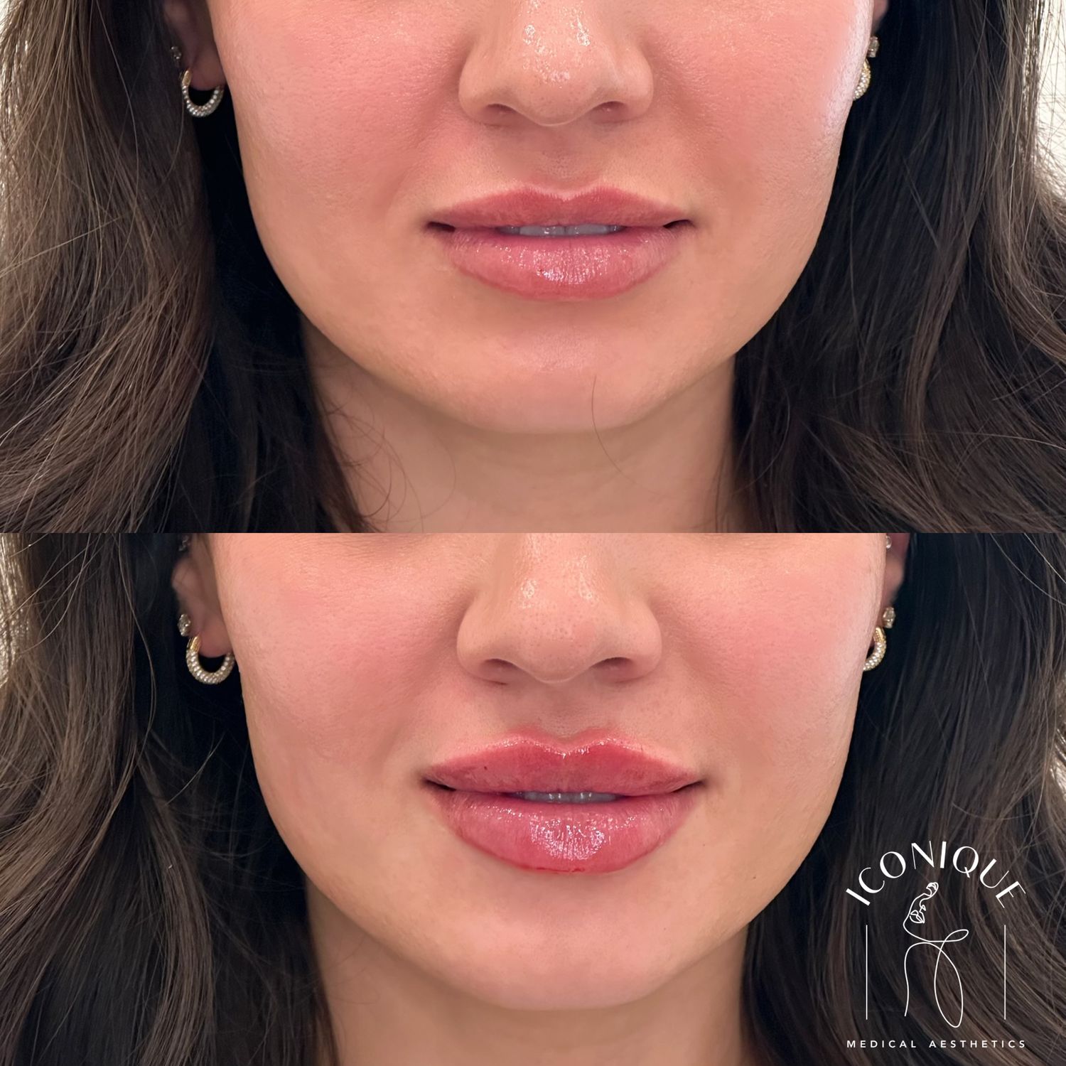 Lip Filler Before & After