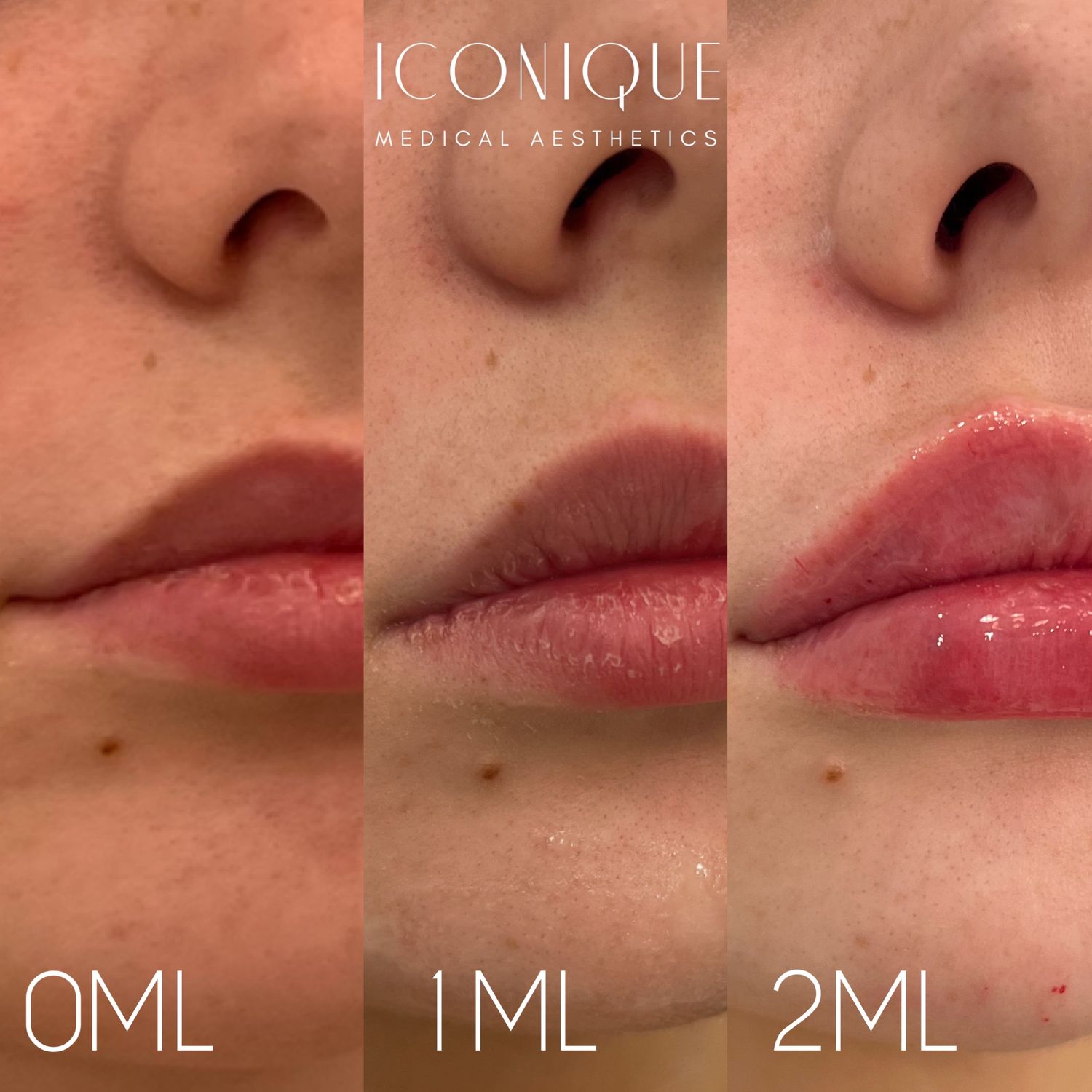 Lip Filler Before & After