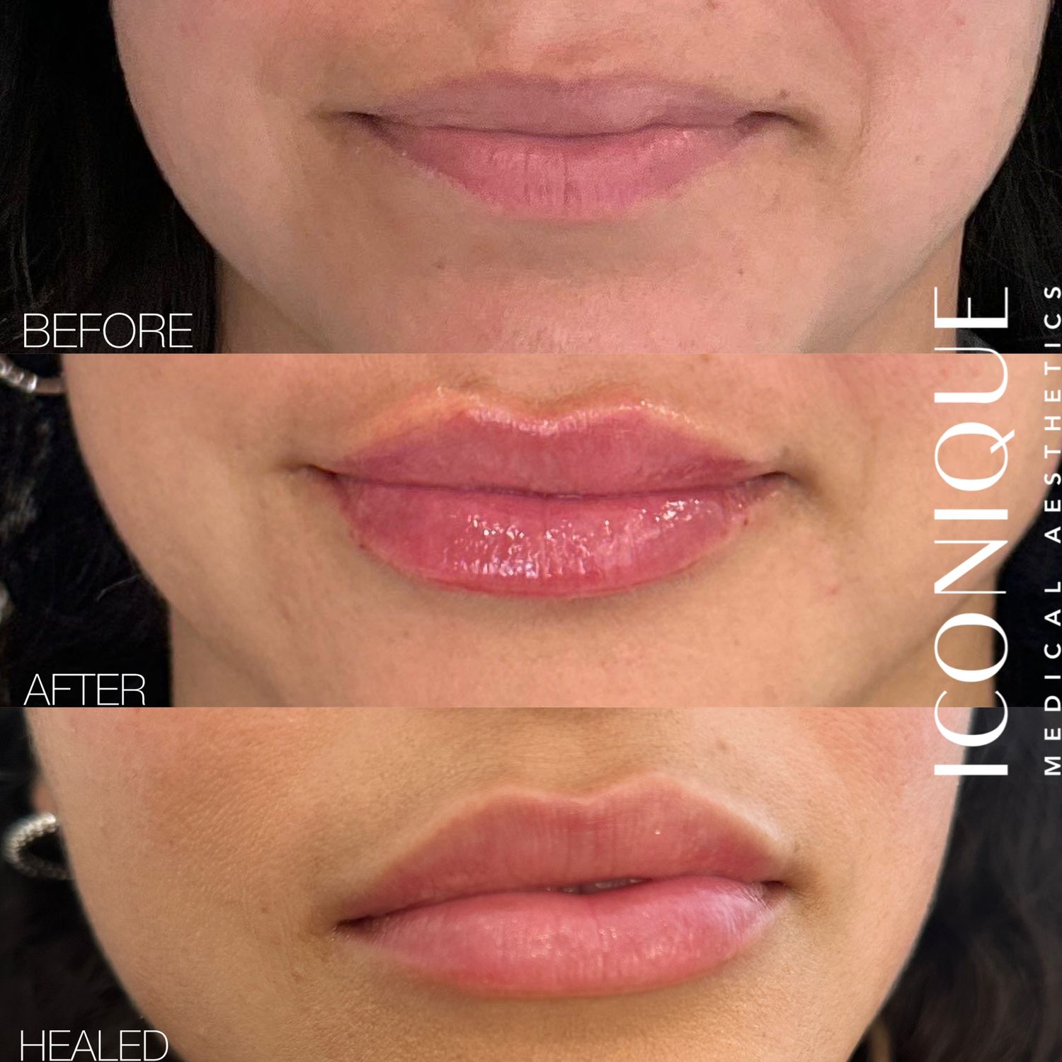 Lip Filler Before & After