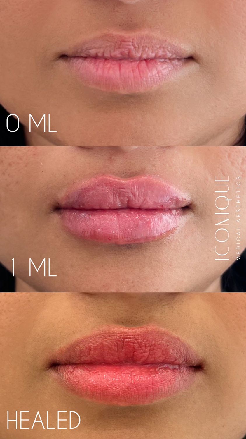 Lip Filler Before & After