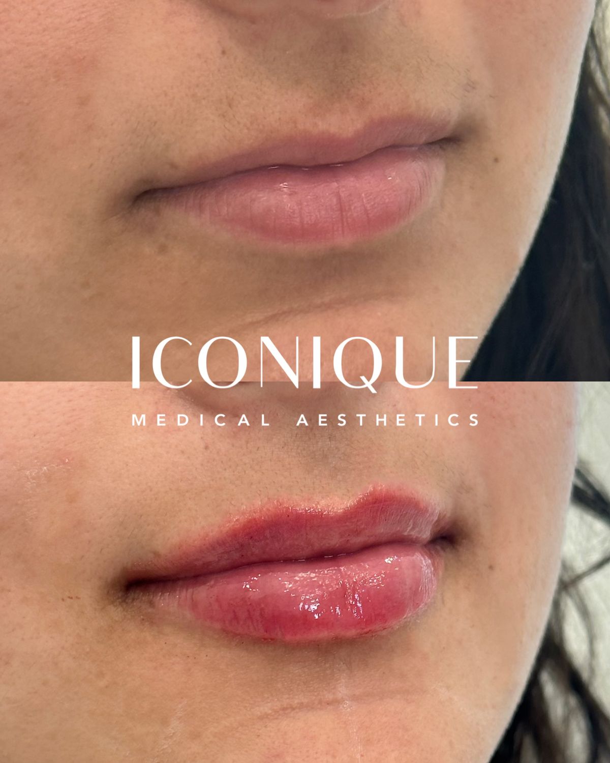 Lip Filler Before & After